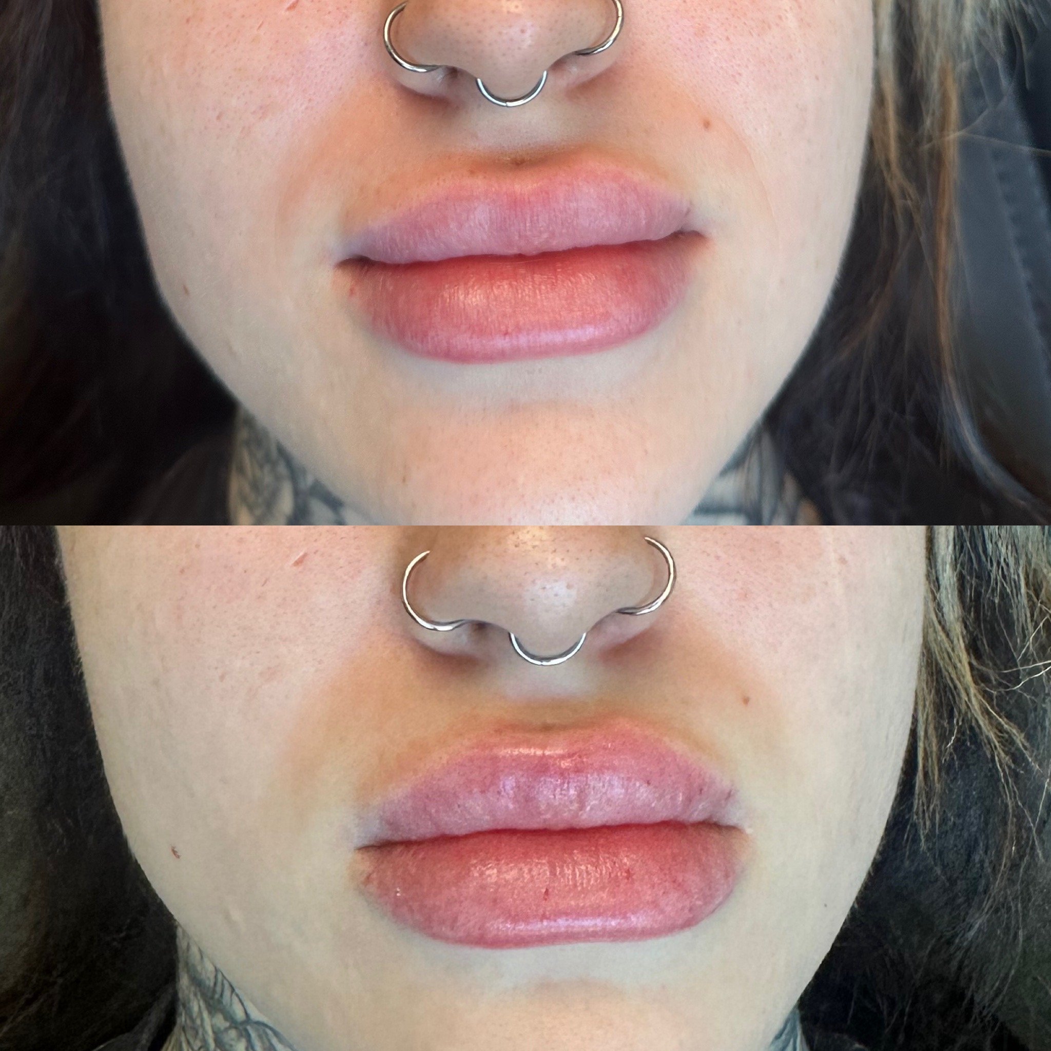 Lip Filler