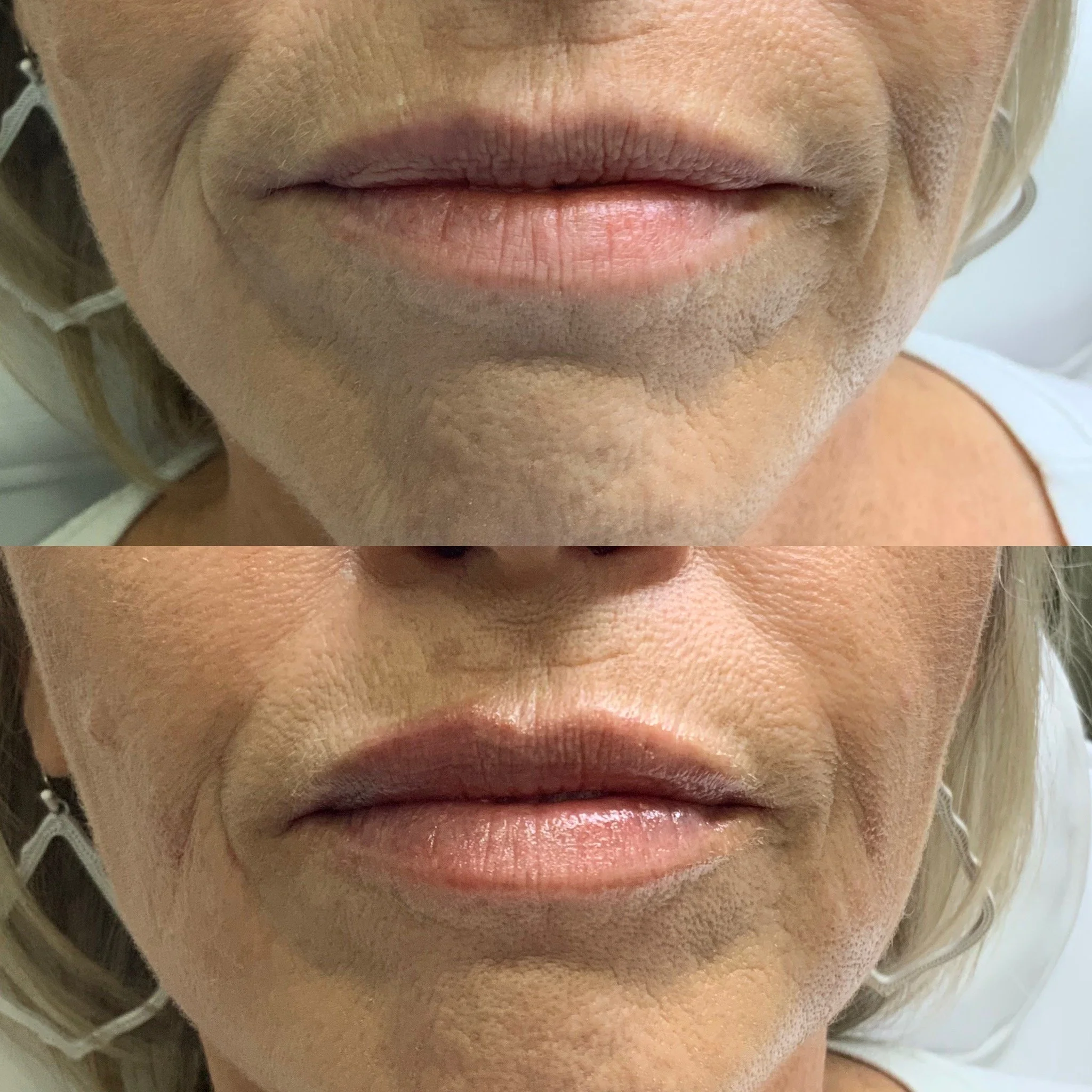 Lip Filler