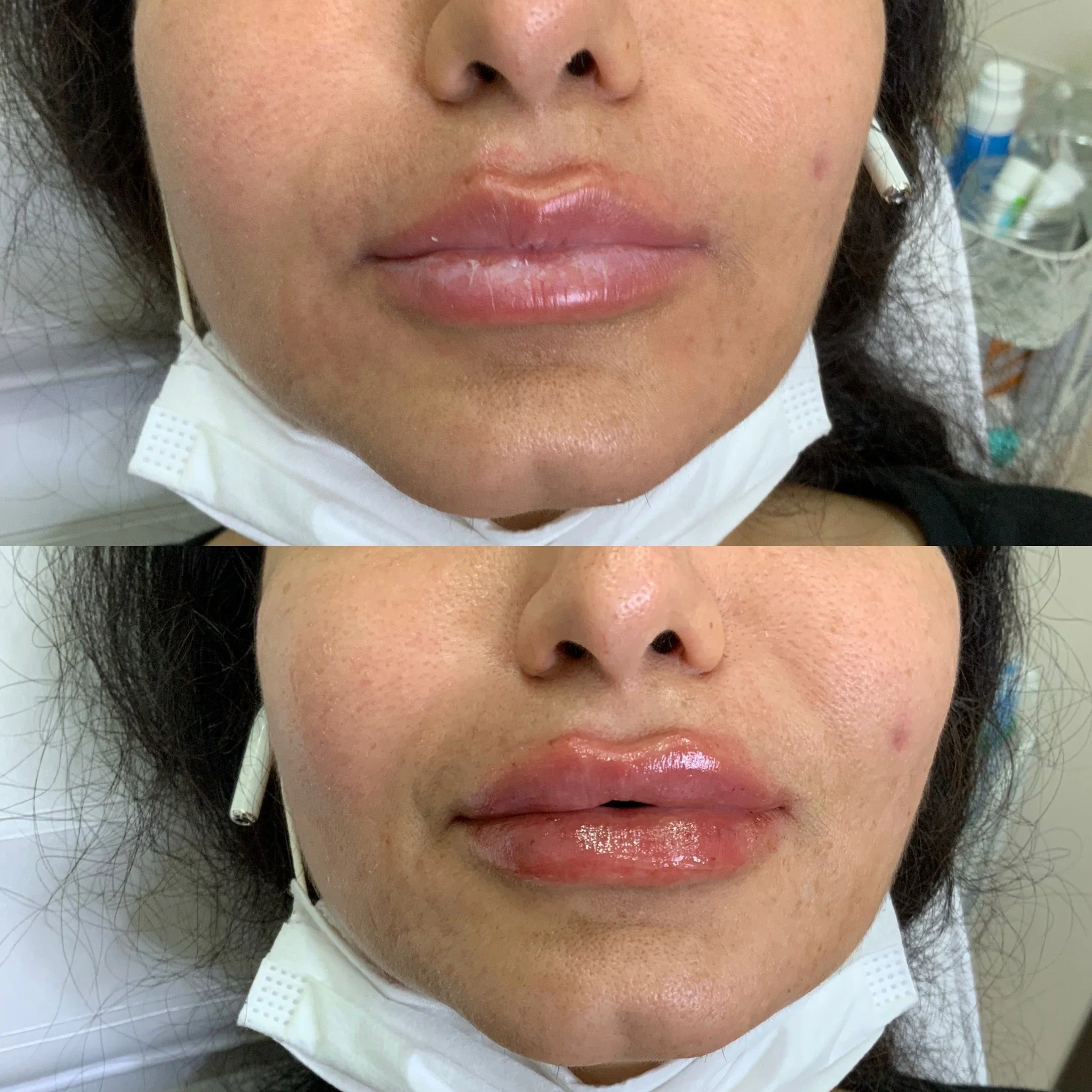 Lip Filler