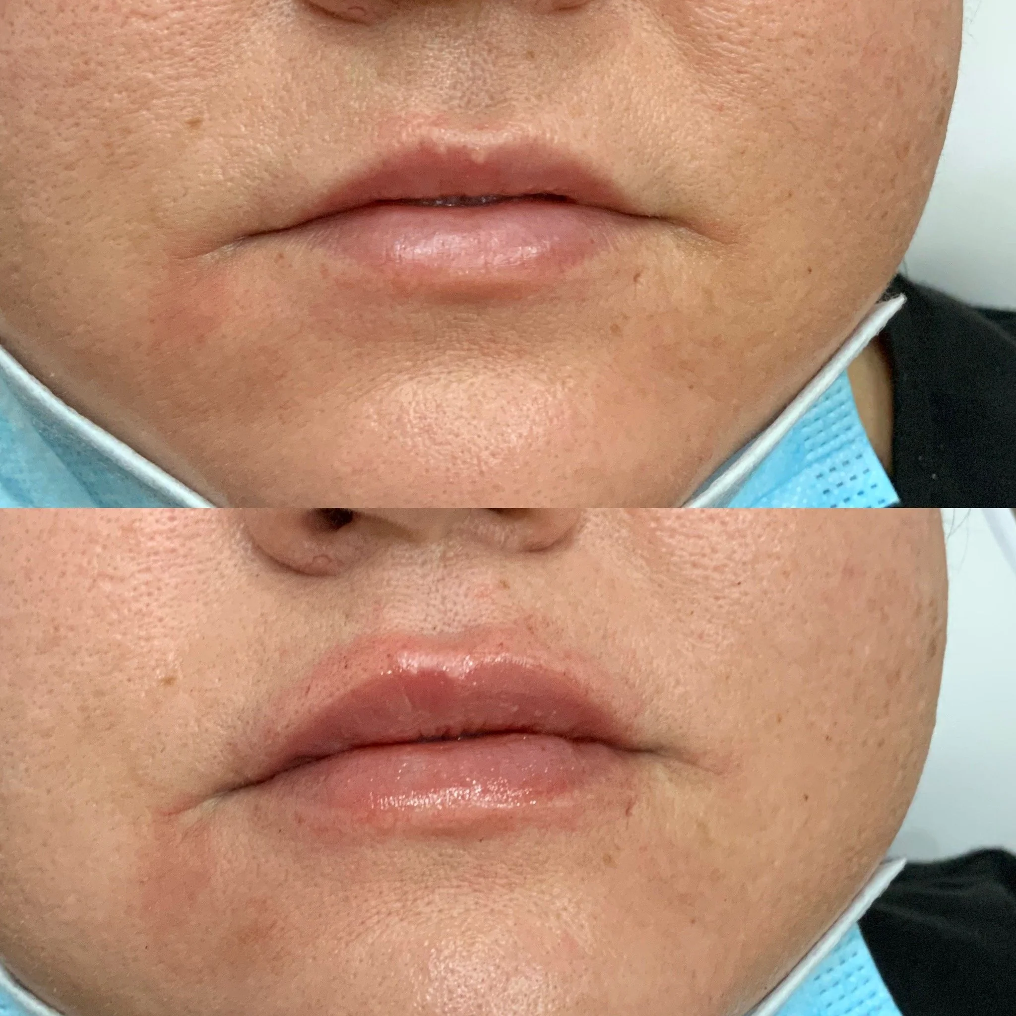 Lip FIller