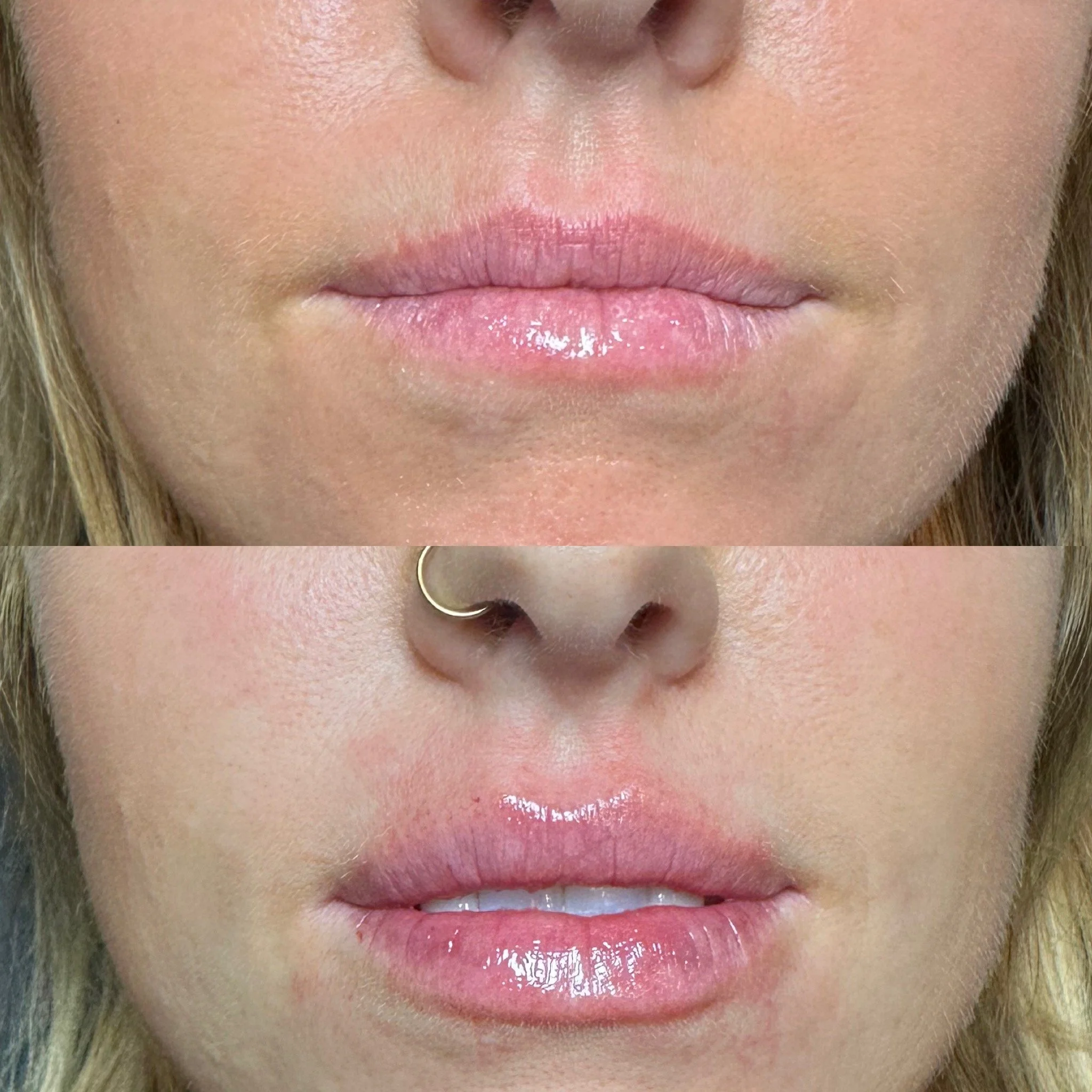 Lip Filler 1 Syringe
