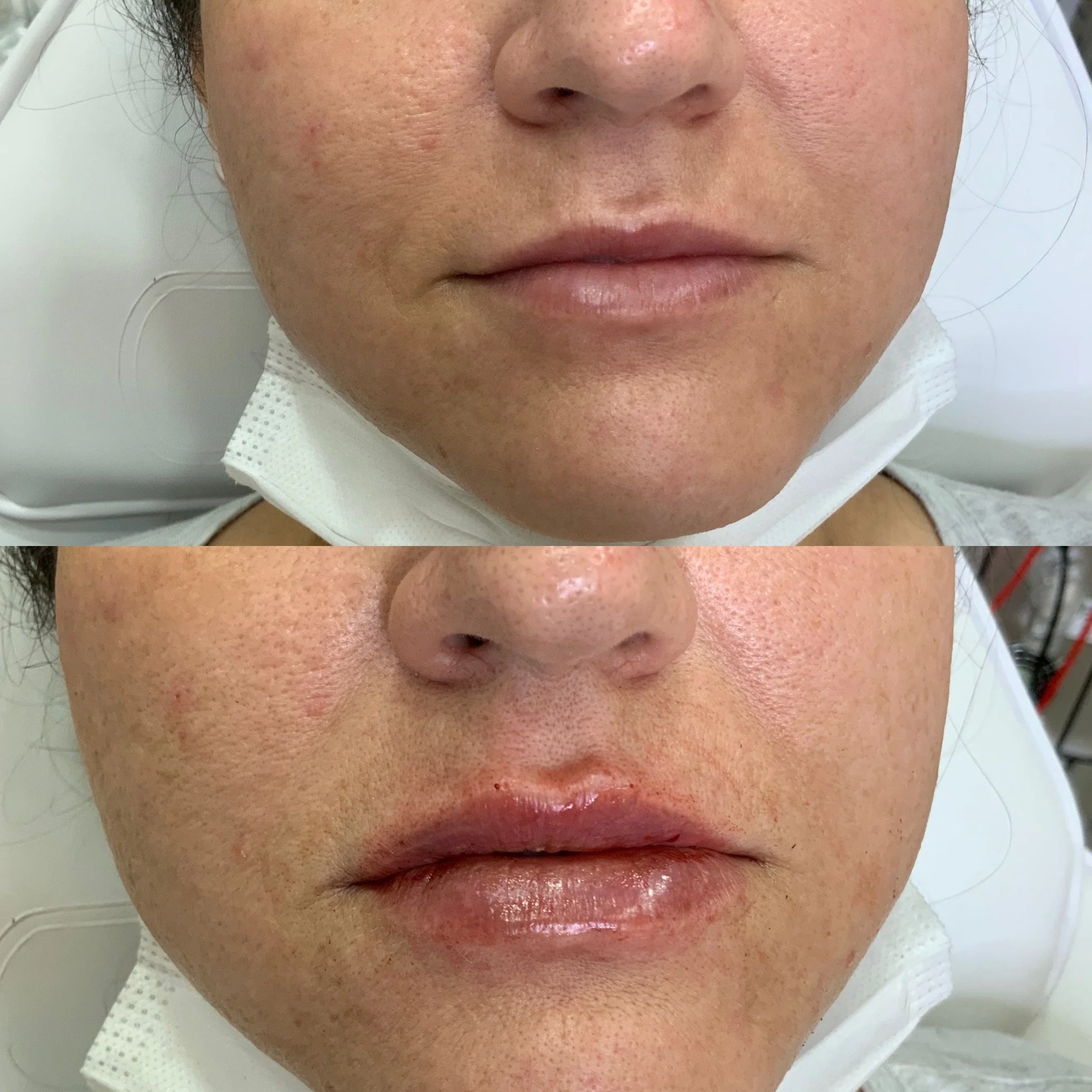 Lip FIller