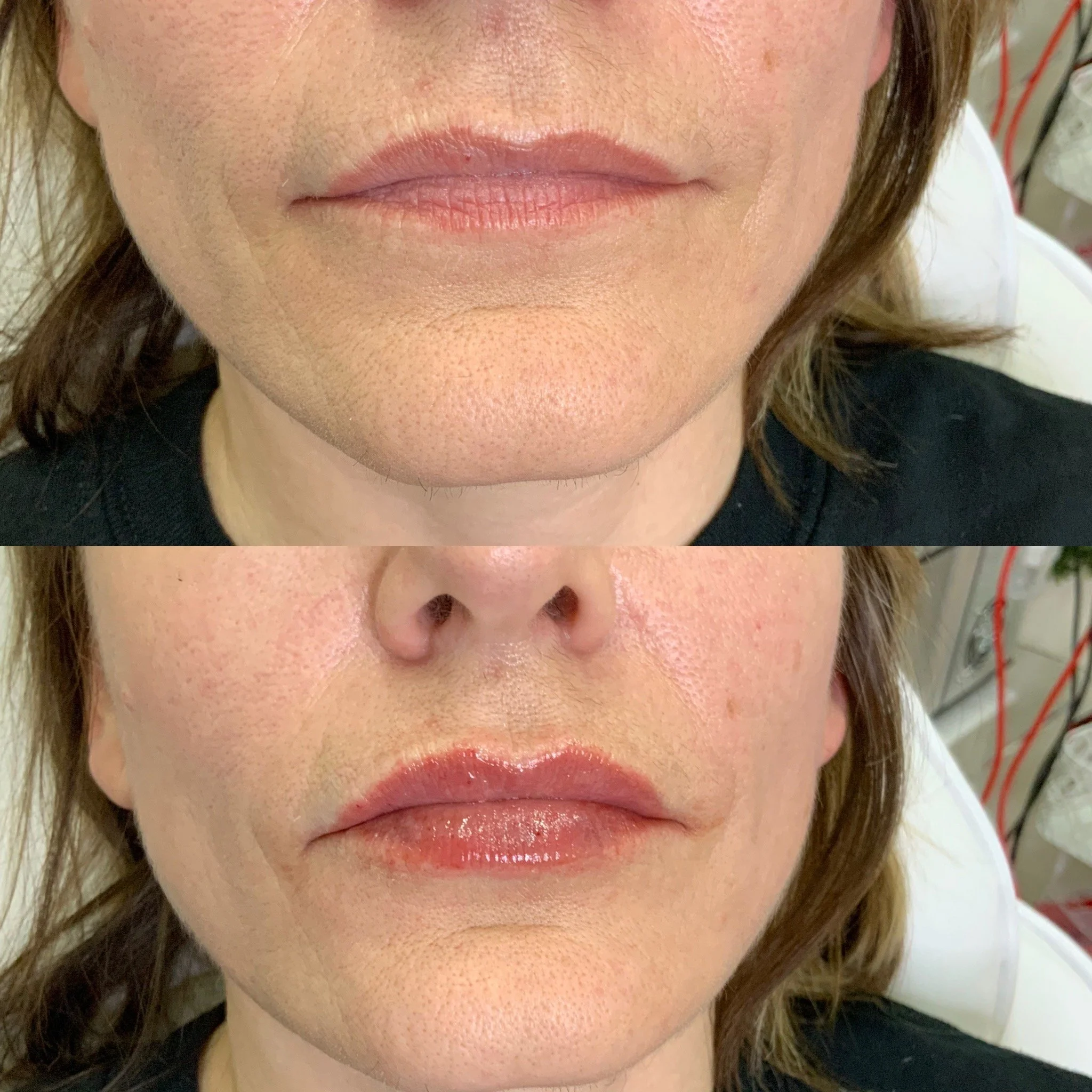Lip FIller