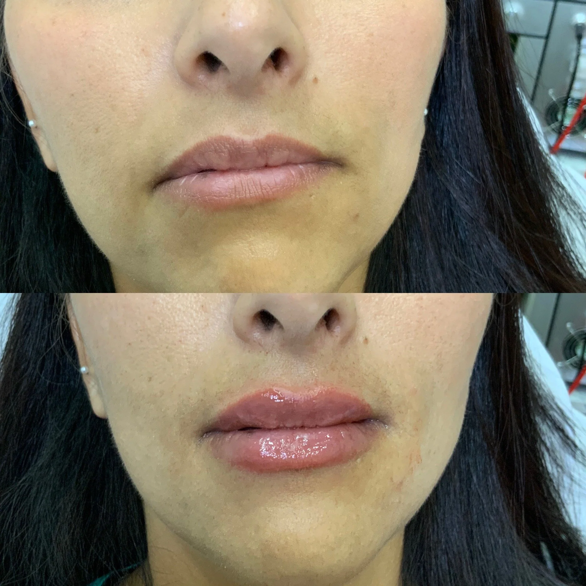 Lip Filler