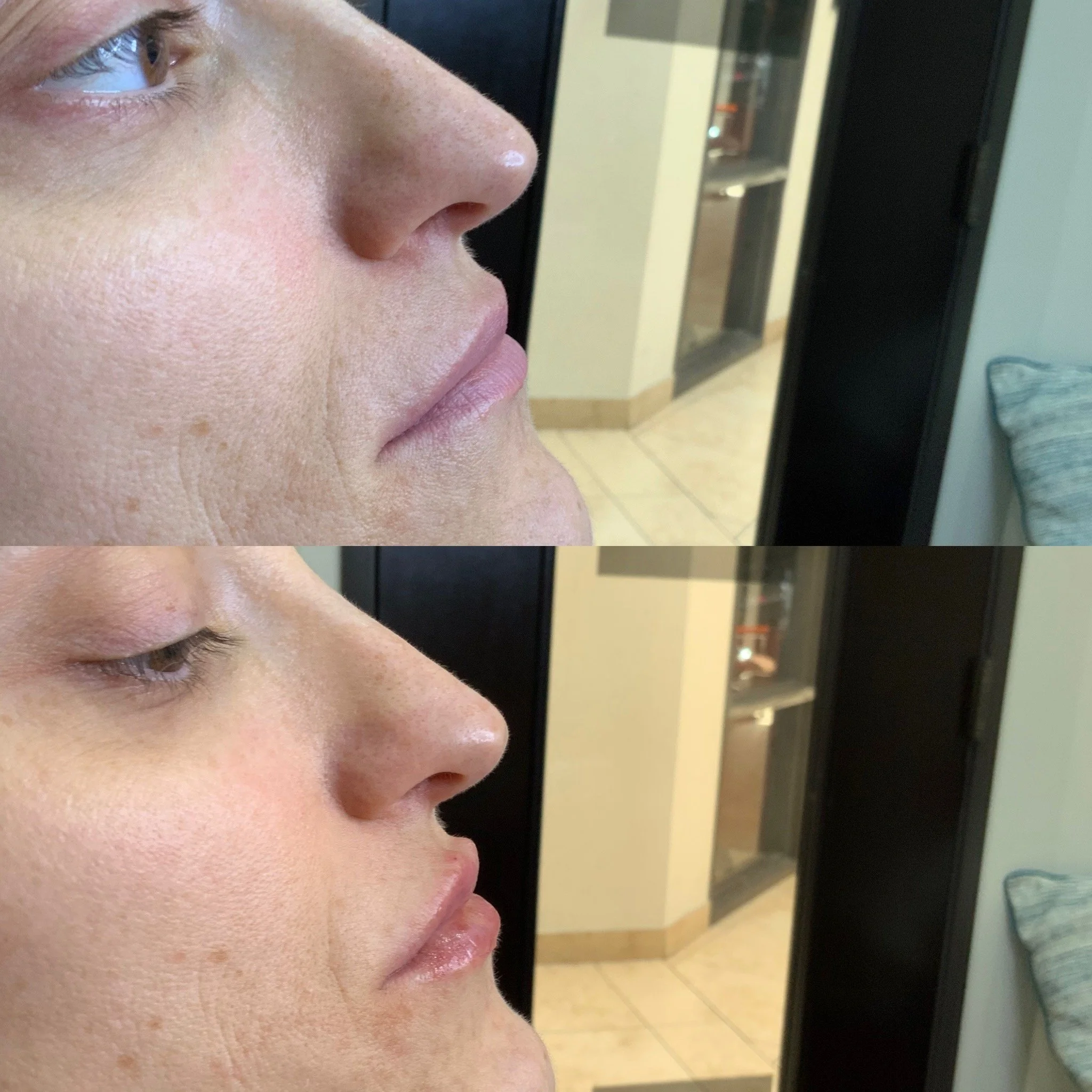 Lip Filler