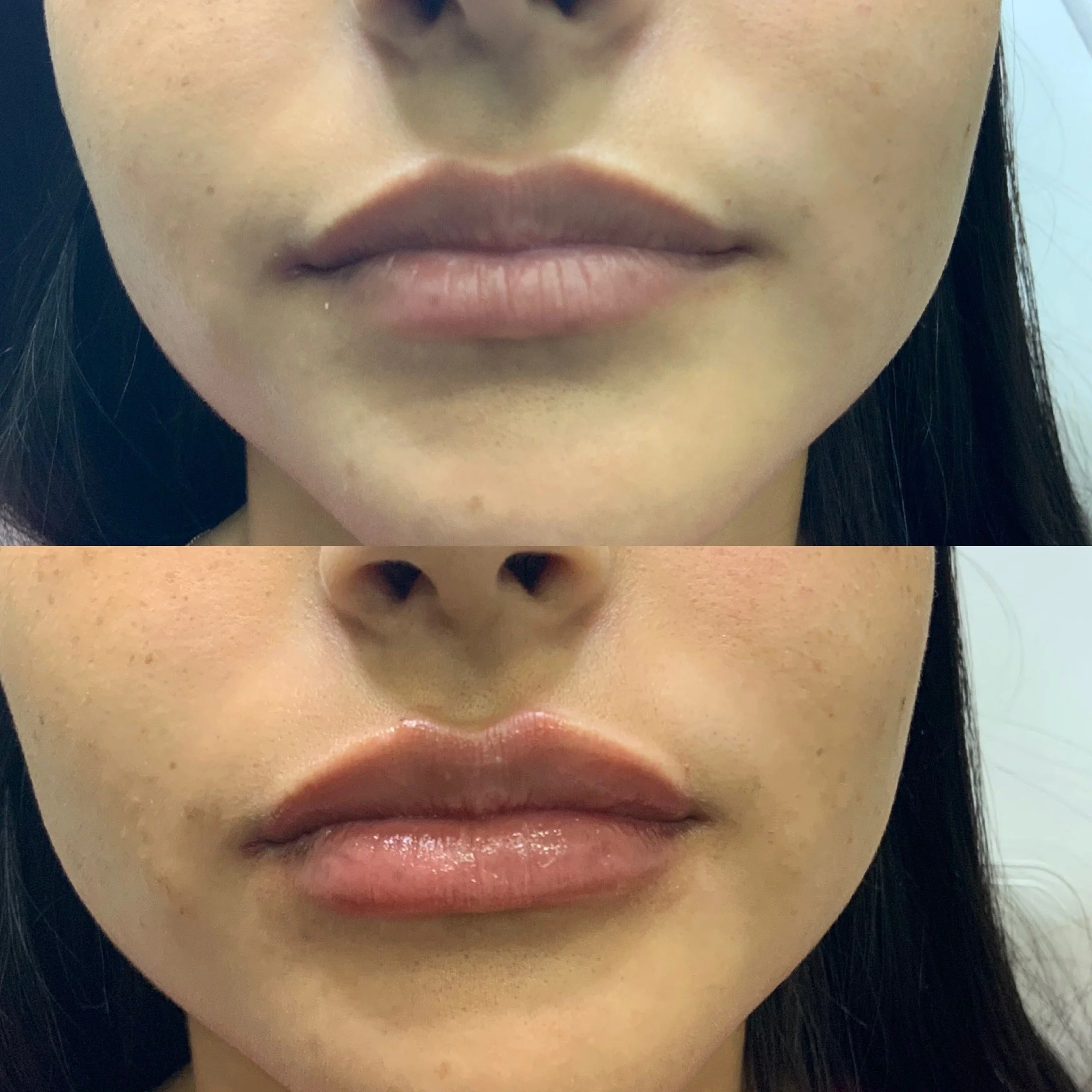 Lip Filler