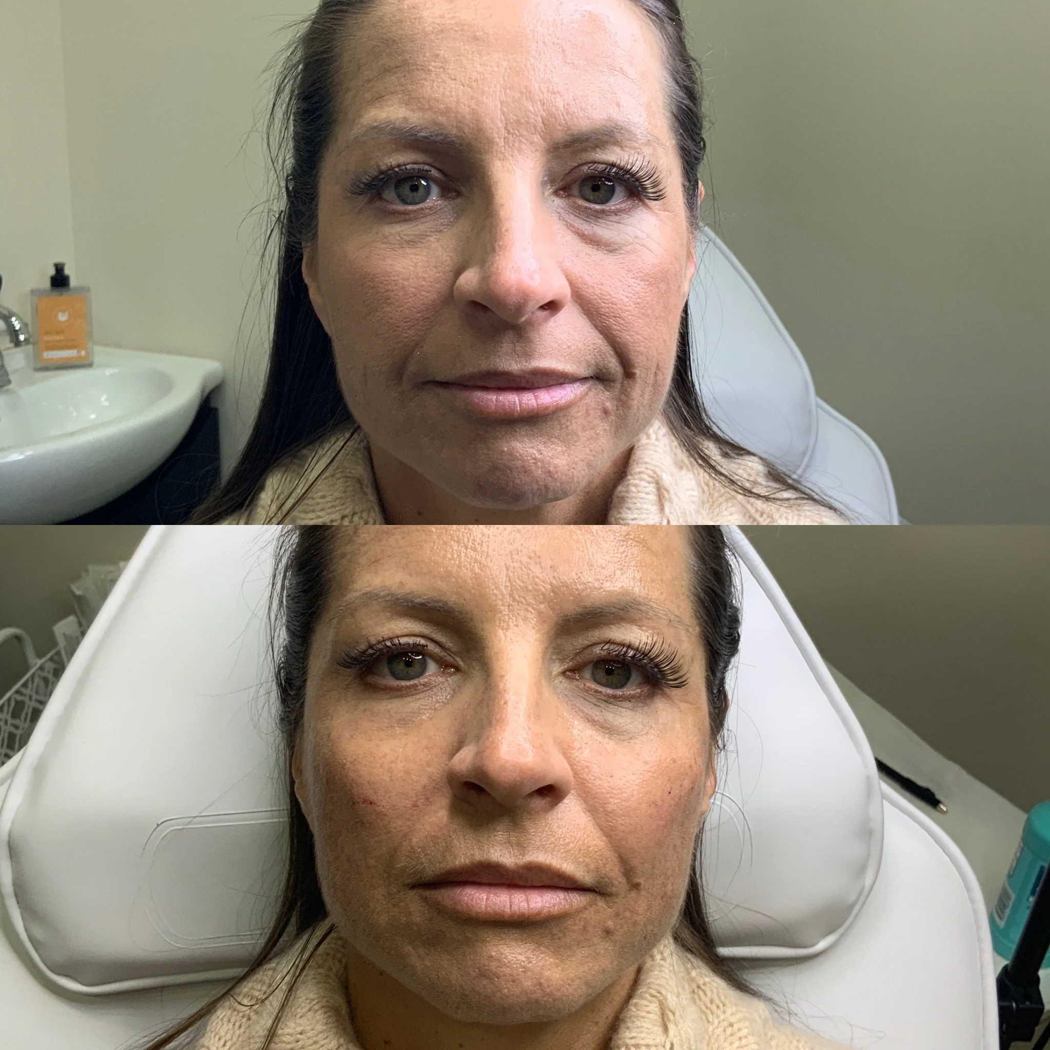 Cheek Filler