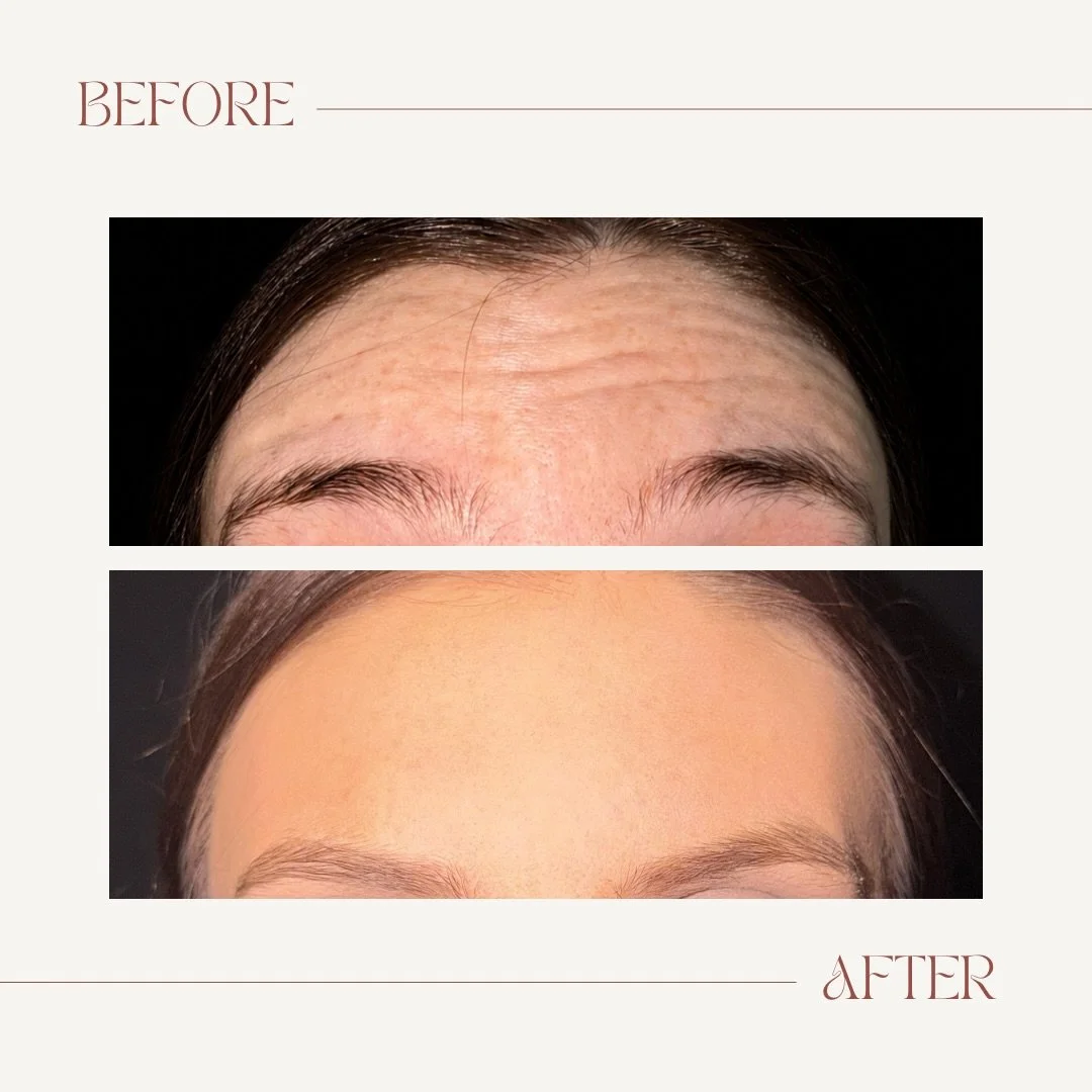 Comparison of eyebrows and forehead with before and after images showing improvement in skin texture and appearance.