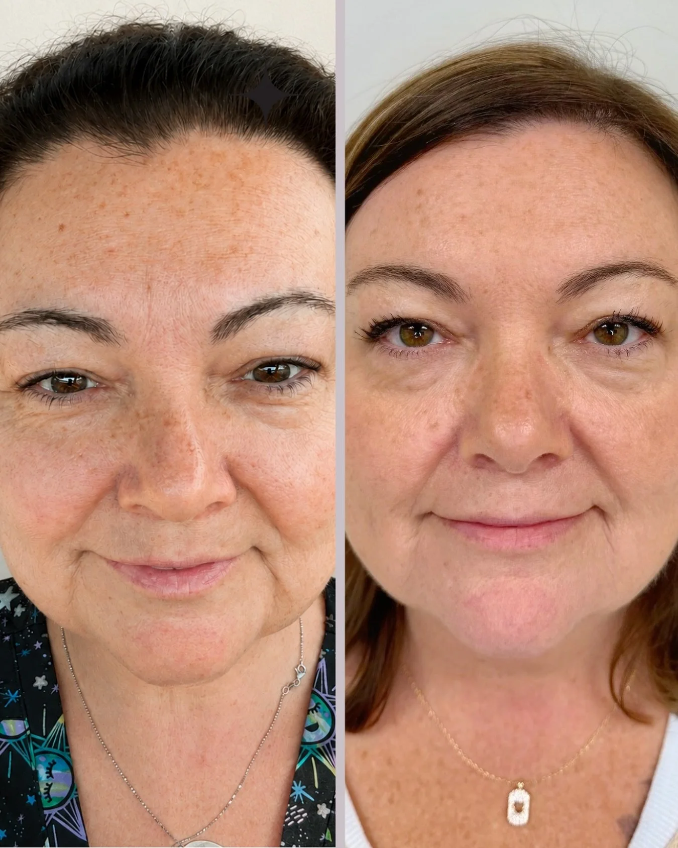 Side-by-side comparison photo showing a woman's face before and after skincare treatment, with improved skin clarity and texture in the after image.