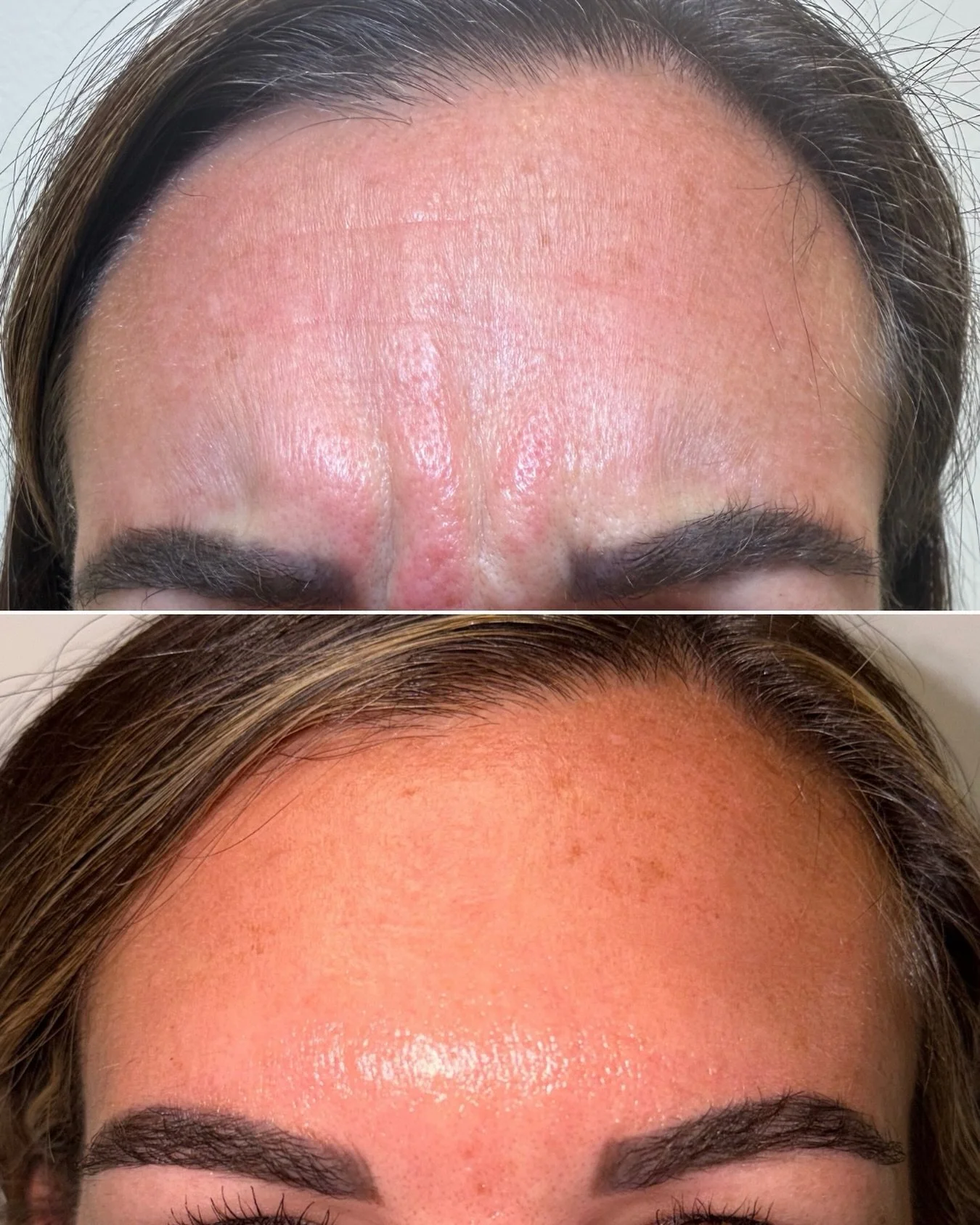 Close-up of a person's forehead before and after skincare treatment, showing significant reduction in redness, pore size, and skin texture improvement.