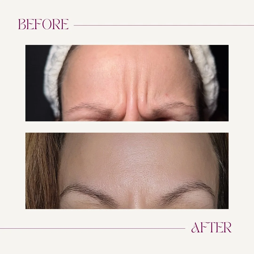 Comparison of forehead wrinkles before and after treatment. Top shows prominent frown lines; bottom shows smoother forehead with reduced wrinkles.