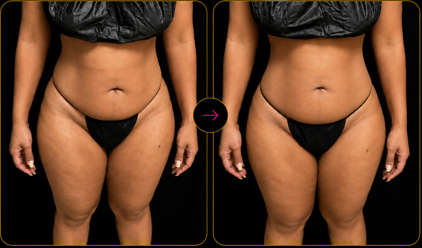 Before and after waist and body sculpting results at Royale Renewal