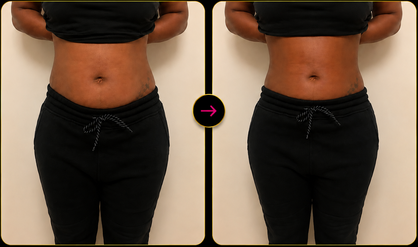 Before and after body contouring transformation at Royale Renewal