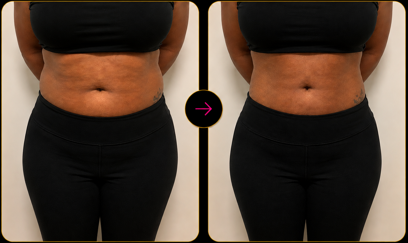 Before and after body transformation following Royale Renewal treatment