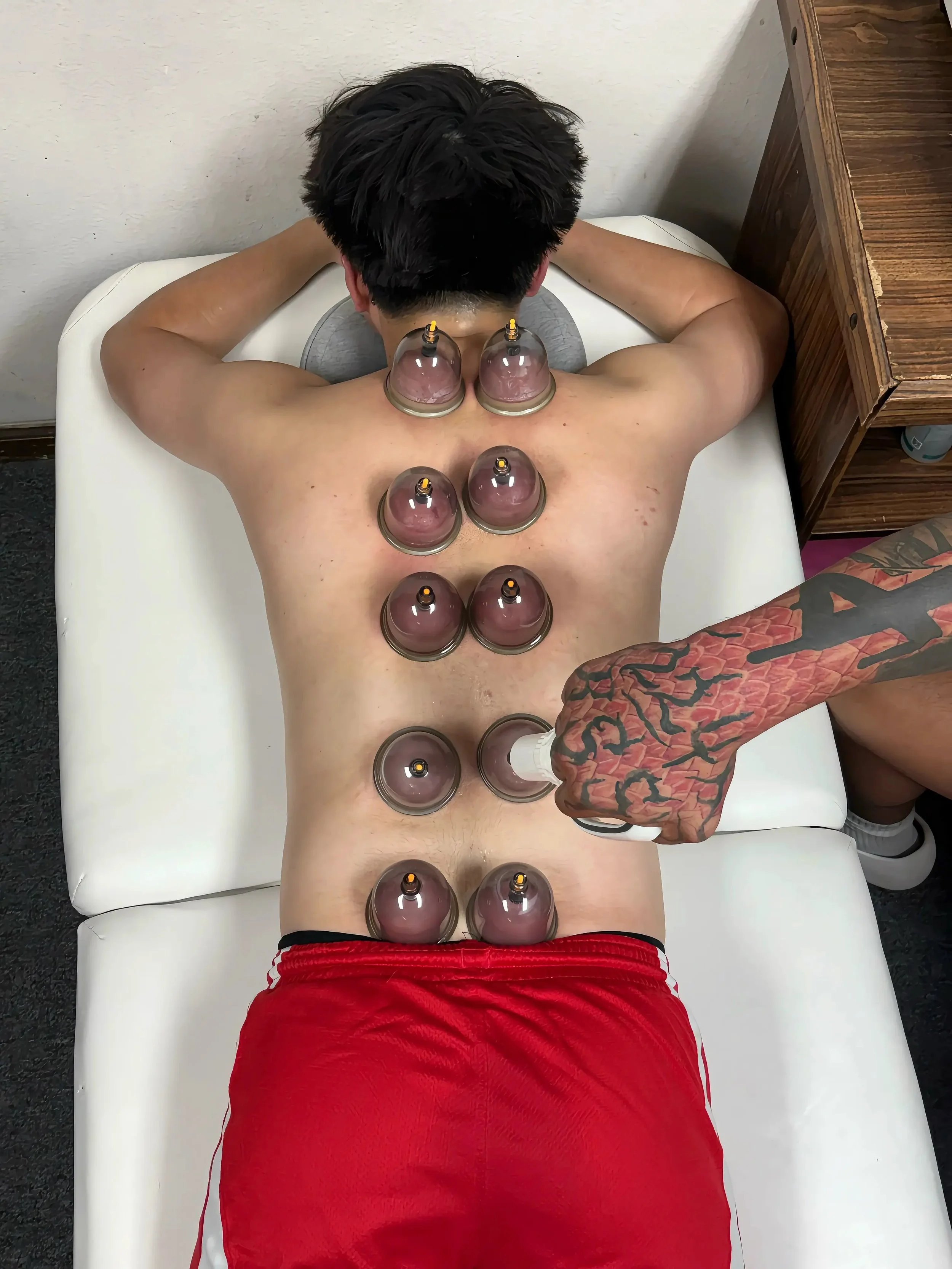 Cupping Therapy - 20 Minutes
