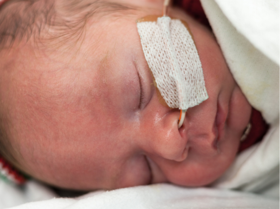 Close-up of a sleeping newborn baby with a nasal feeding tube secured with medical tape on the nose.