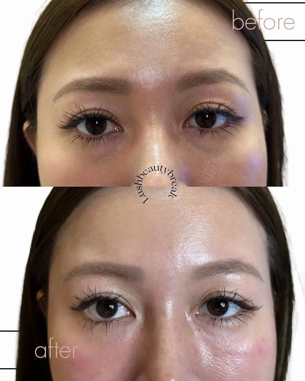 Tear trough filler is strategically placed beneath the eyes to restore lost volume, soften hollows, and reduce the look of dark shadowing for a refreshed and well rested appearance.