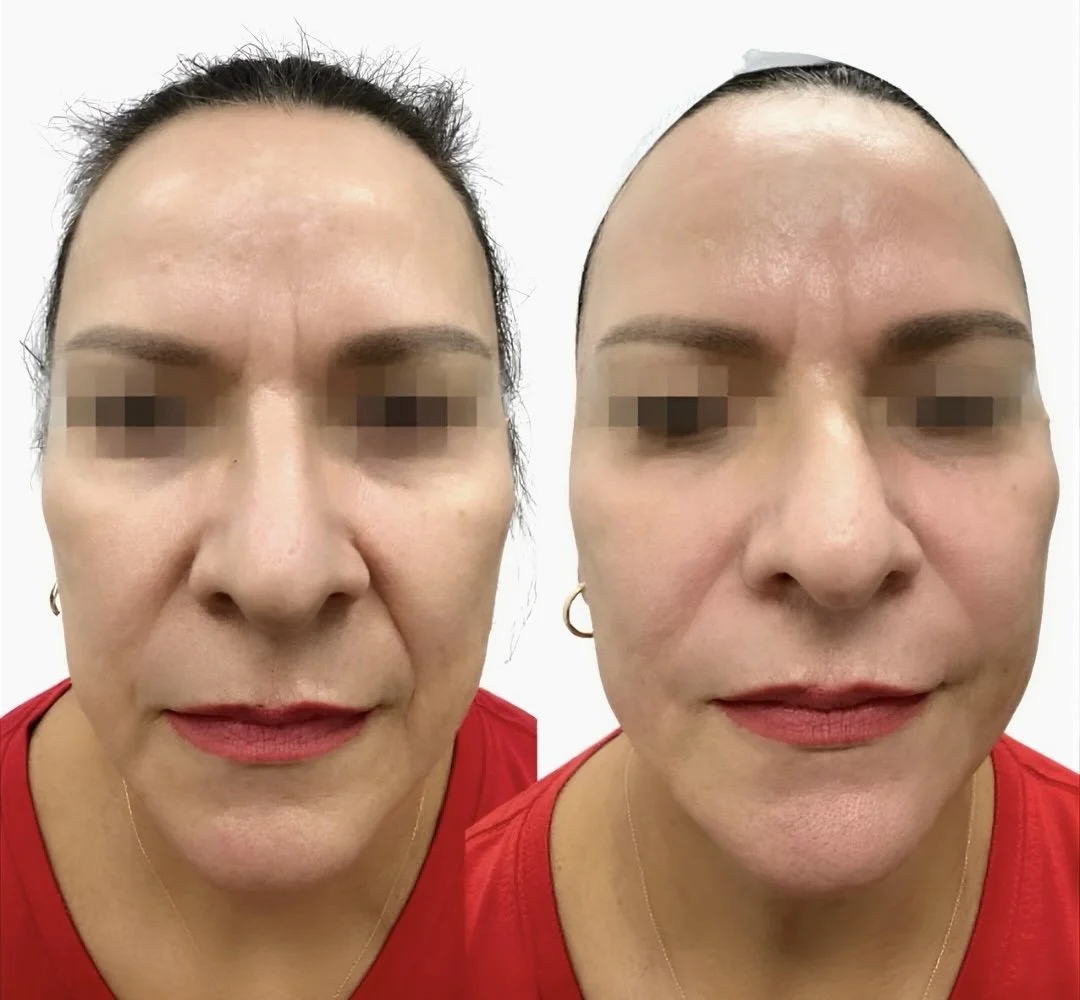 Side-by-side comparison of a woman's face before and after a cosmetic procedure, showing improvements in skin smoothness and texture with face balancing using fillers.
