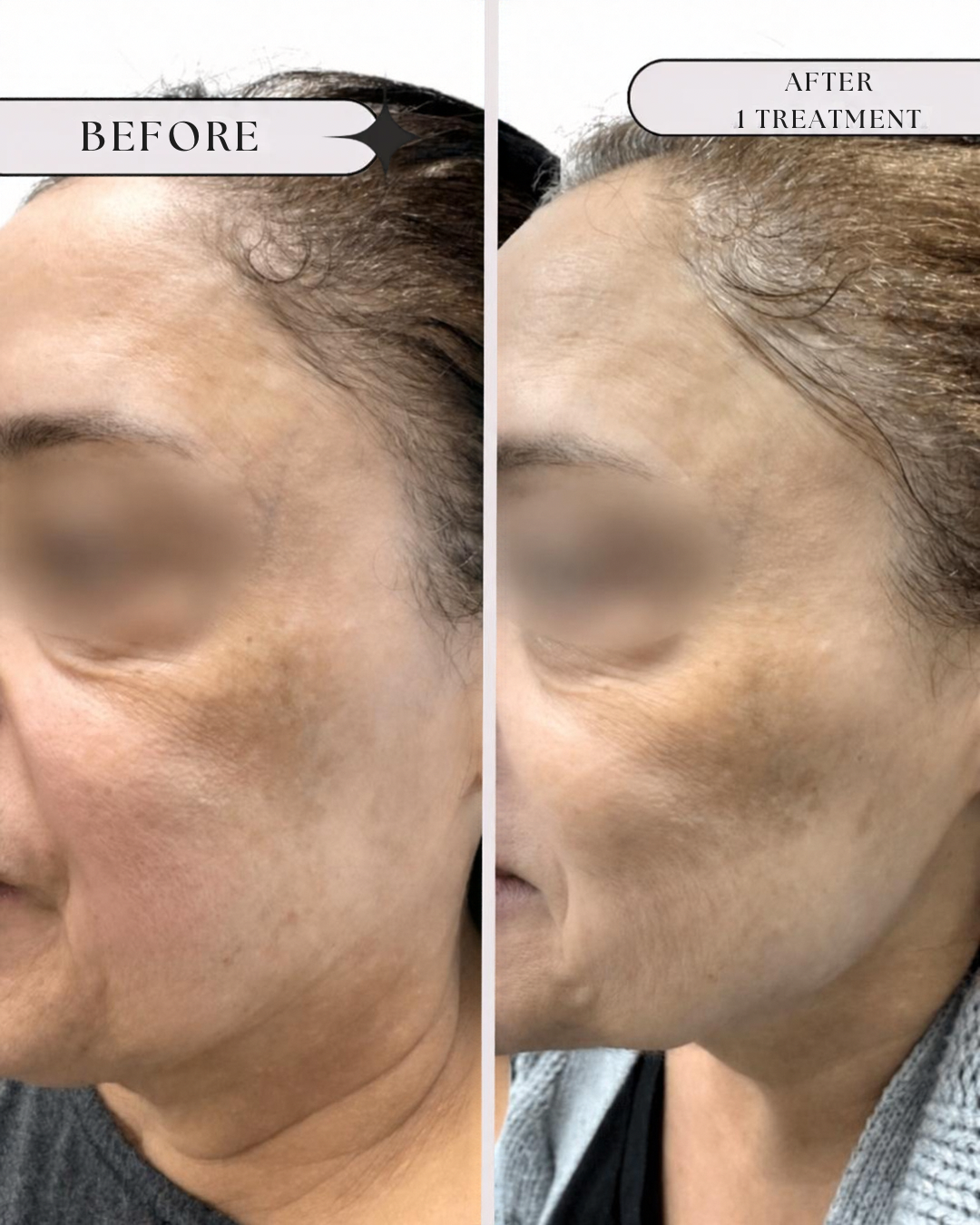 Side-by-side comparison of a woman's face showing the effects of a skin treatment, with 'before' on the left and 'after one treatment' on the right, highlighting improved skin texture and clarity from  microneedling with PRP.