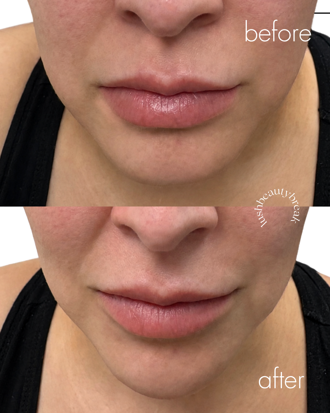 Before and after comparison of lip area showing enhanced lips in the after photo with smoother skin and more defined chin using fillers.