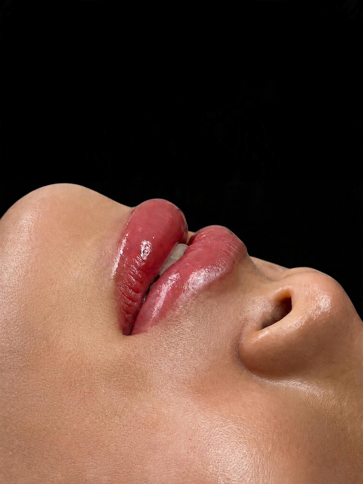 beauty, beautiful Lip enhancement, lip injections, filler, medusa, 