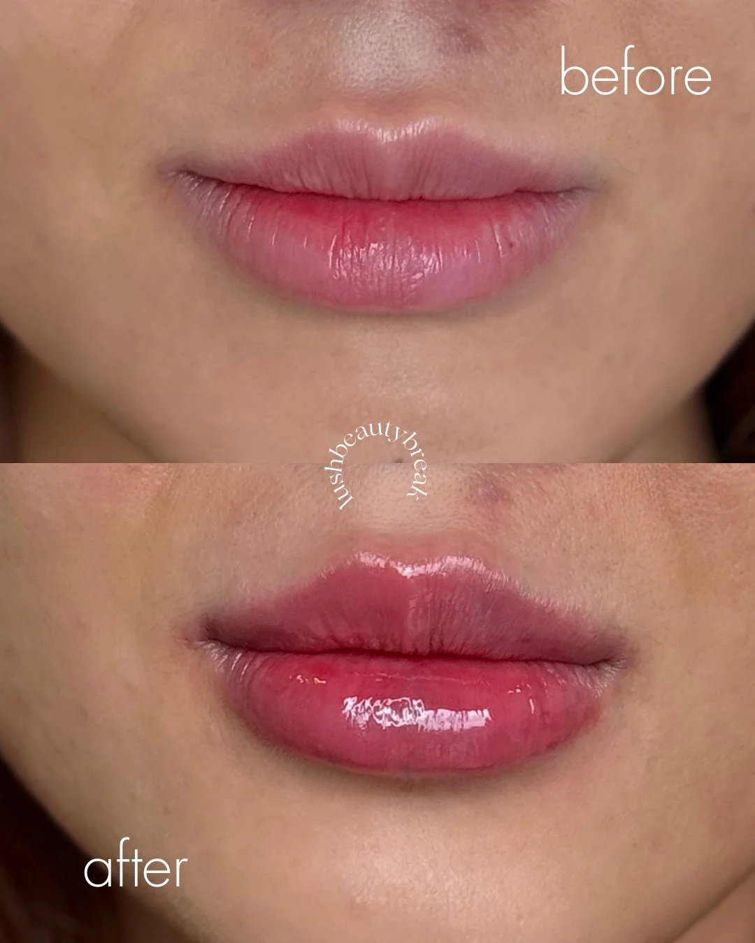 Close-up of lips before and after applying lip filler injection.