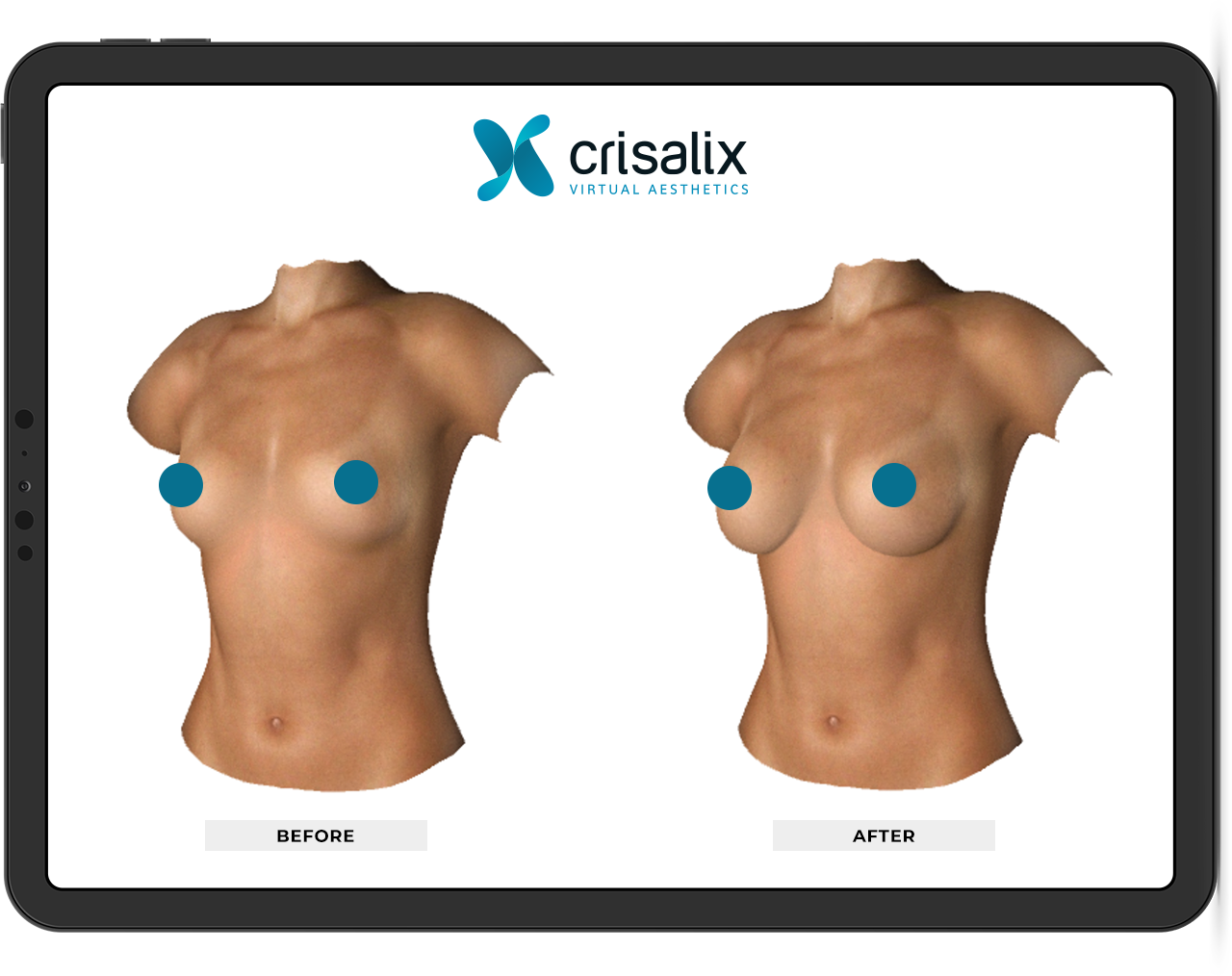 Image montrant une comparaison avant et après de la chirurgie mammaire, avec des modèles de corps féminin sans tête, illustrant une augmentation de la taille des seins.