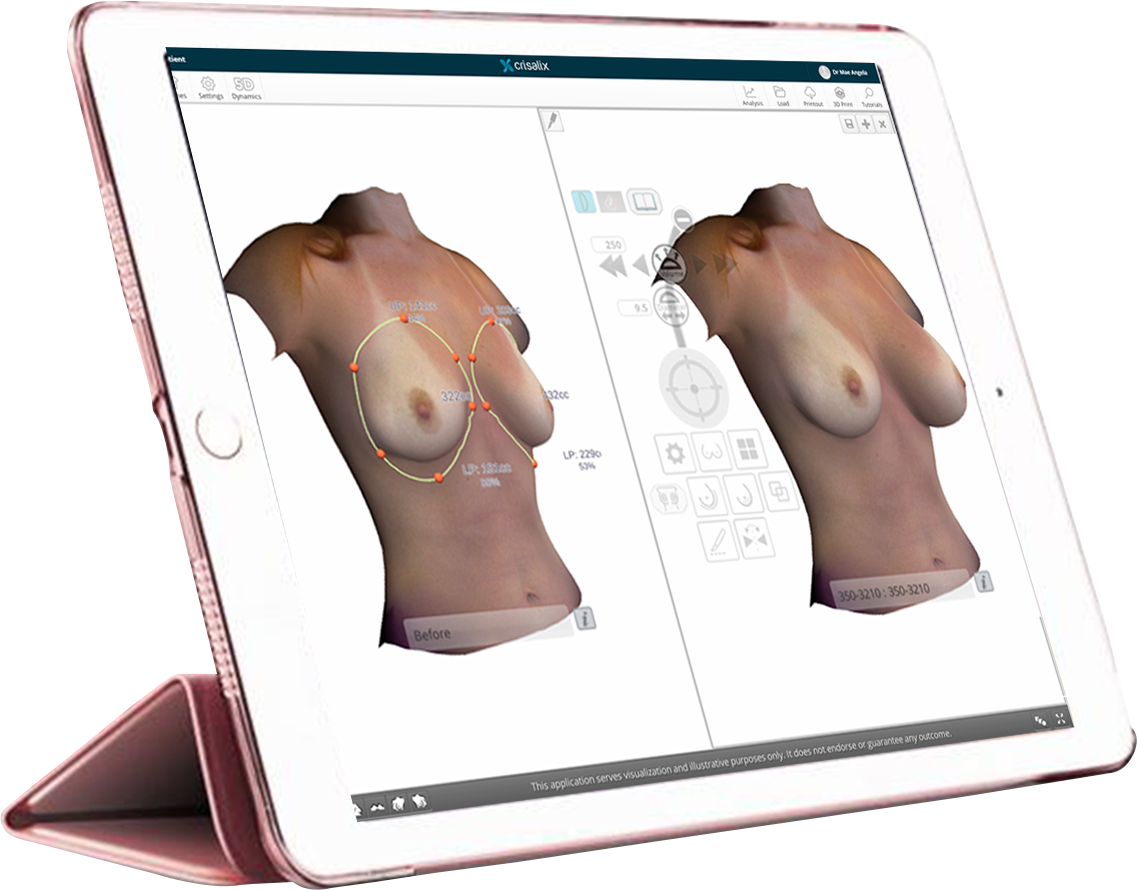Tablette rose affichant un logiciel de modélisation 3D de corps féminin, avec images de seins avant et après augmentation mammaire.