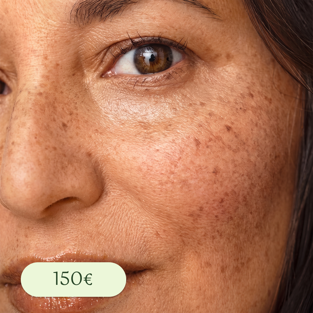 Primer plano de rostro con piel con manchas solares, zona de mejilla y ojo visible. Tiene un precio de 150€.