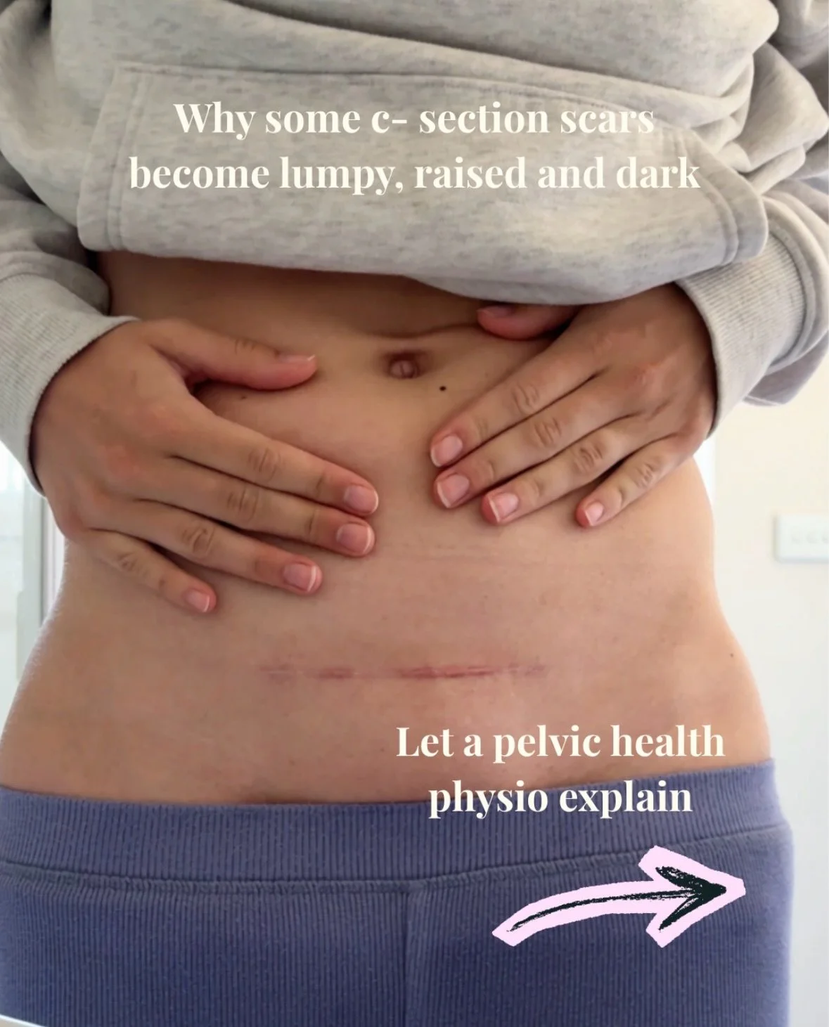 Not sure why your c- section scar is lumpy, raised and dark? Swipe through to learn about hypertrophic scars, why they happen and how you can help them fade over time 👉 

#csection #csectionscar #csectionrecovery #csectionmama #csectionbelly