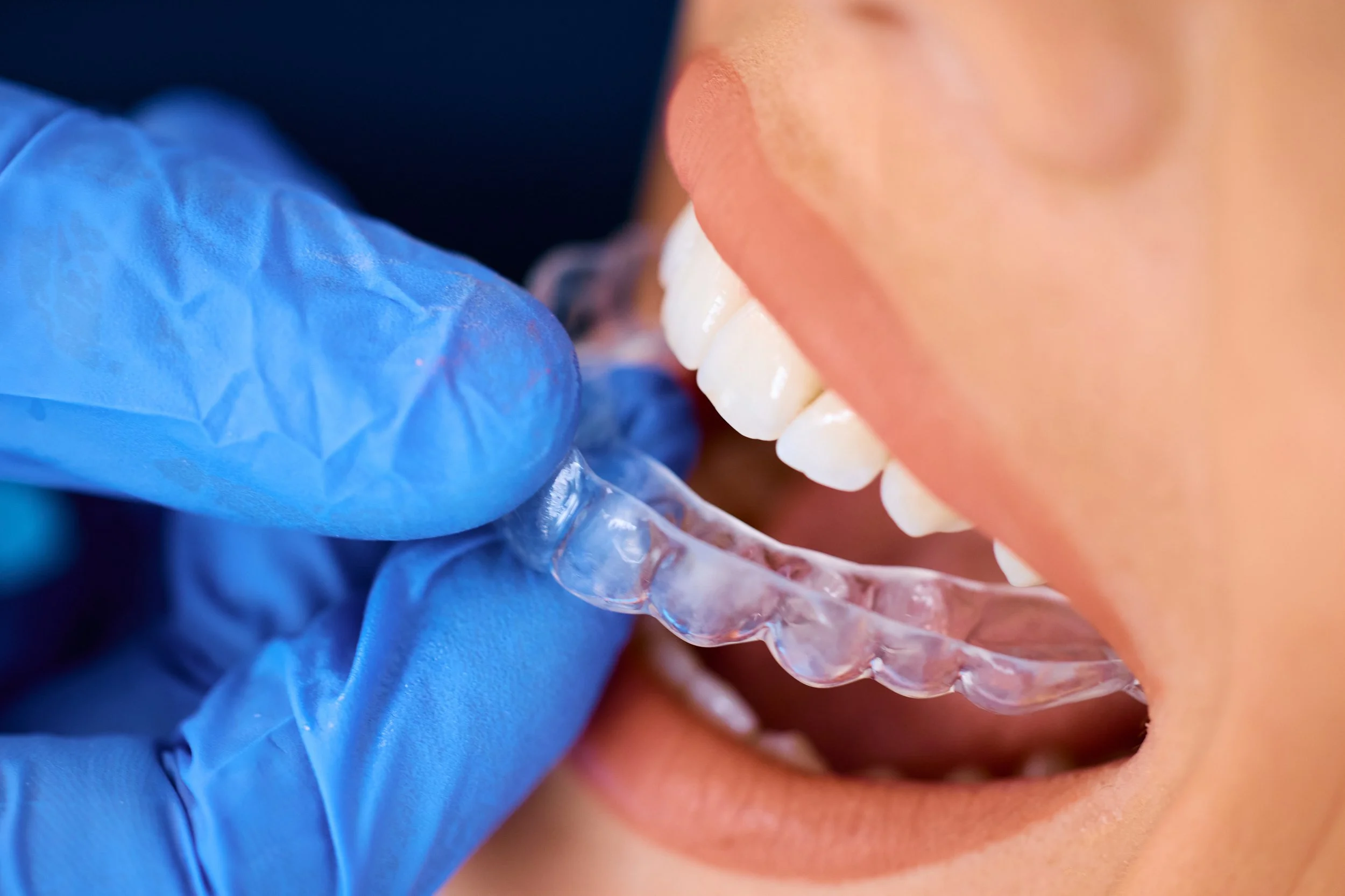 Paciente sonriendo con boca abierta durante tratamiento dental, con un alineadores visible y guantes azules del dentista.