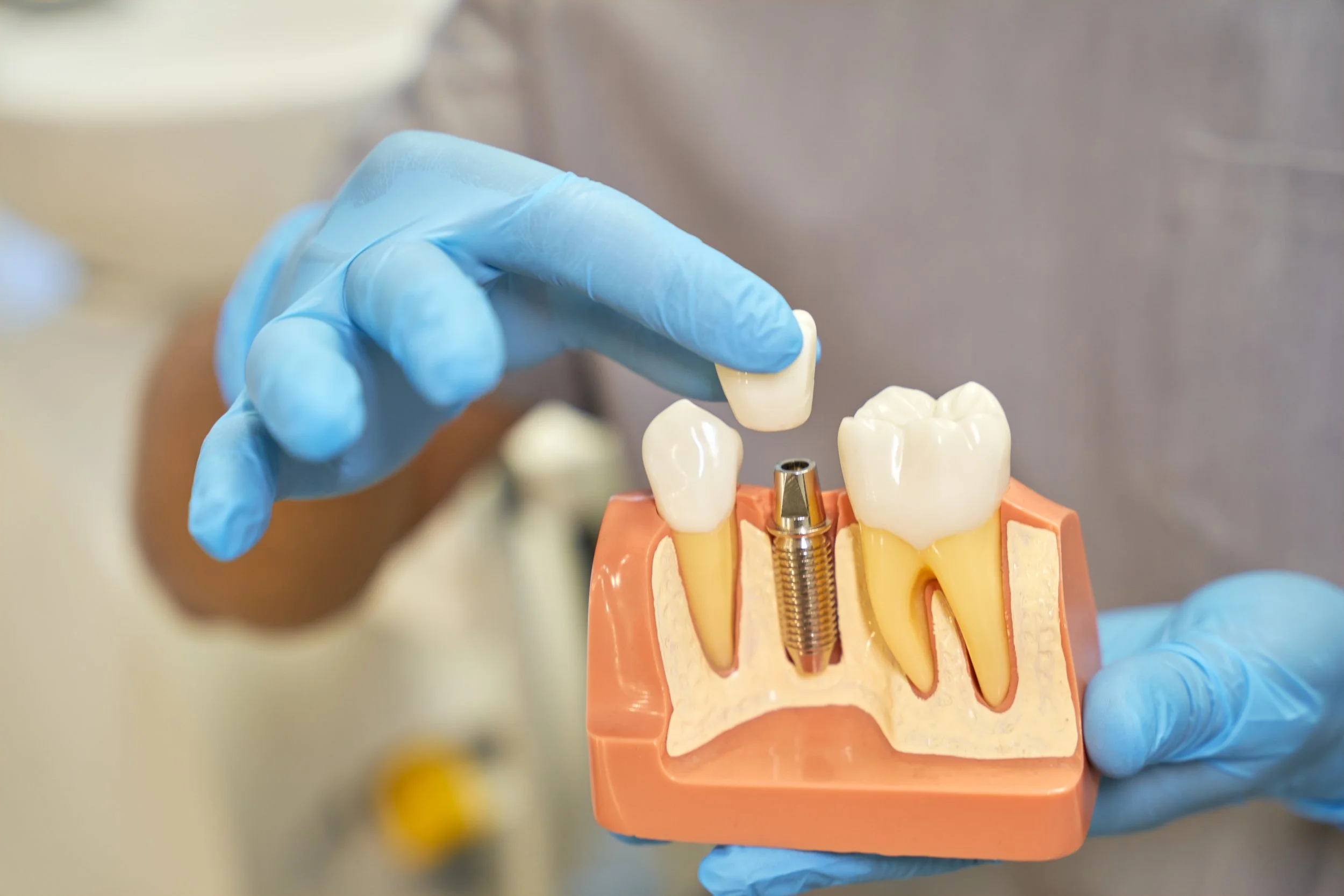 Modelo dental de dientes con implantes en una base de plástico, sostenido por una persona con guantes de látex azules.