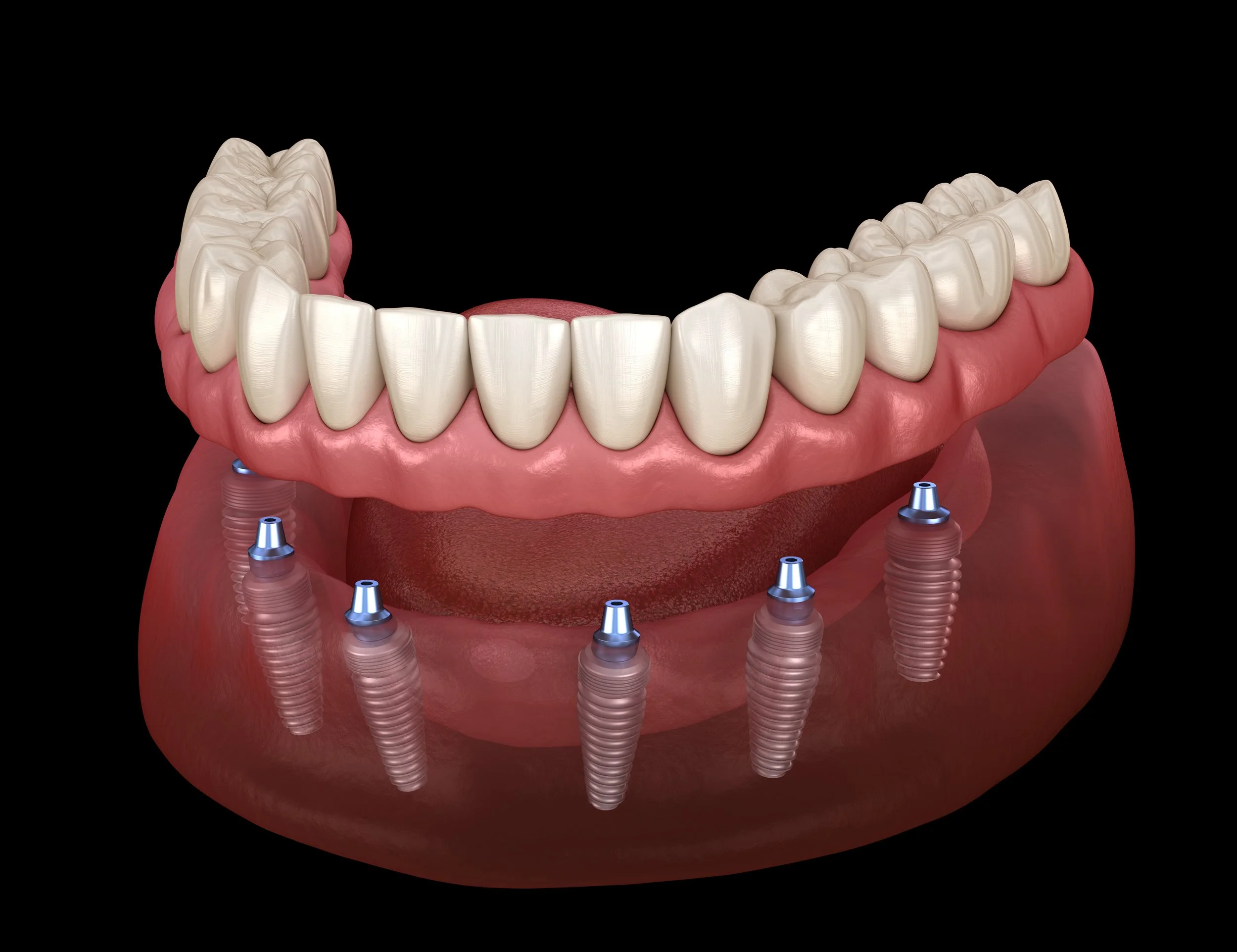 Implant supported "over denture"