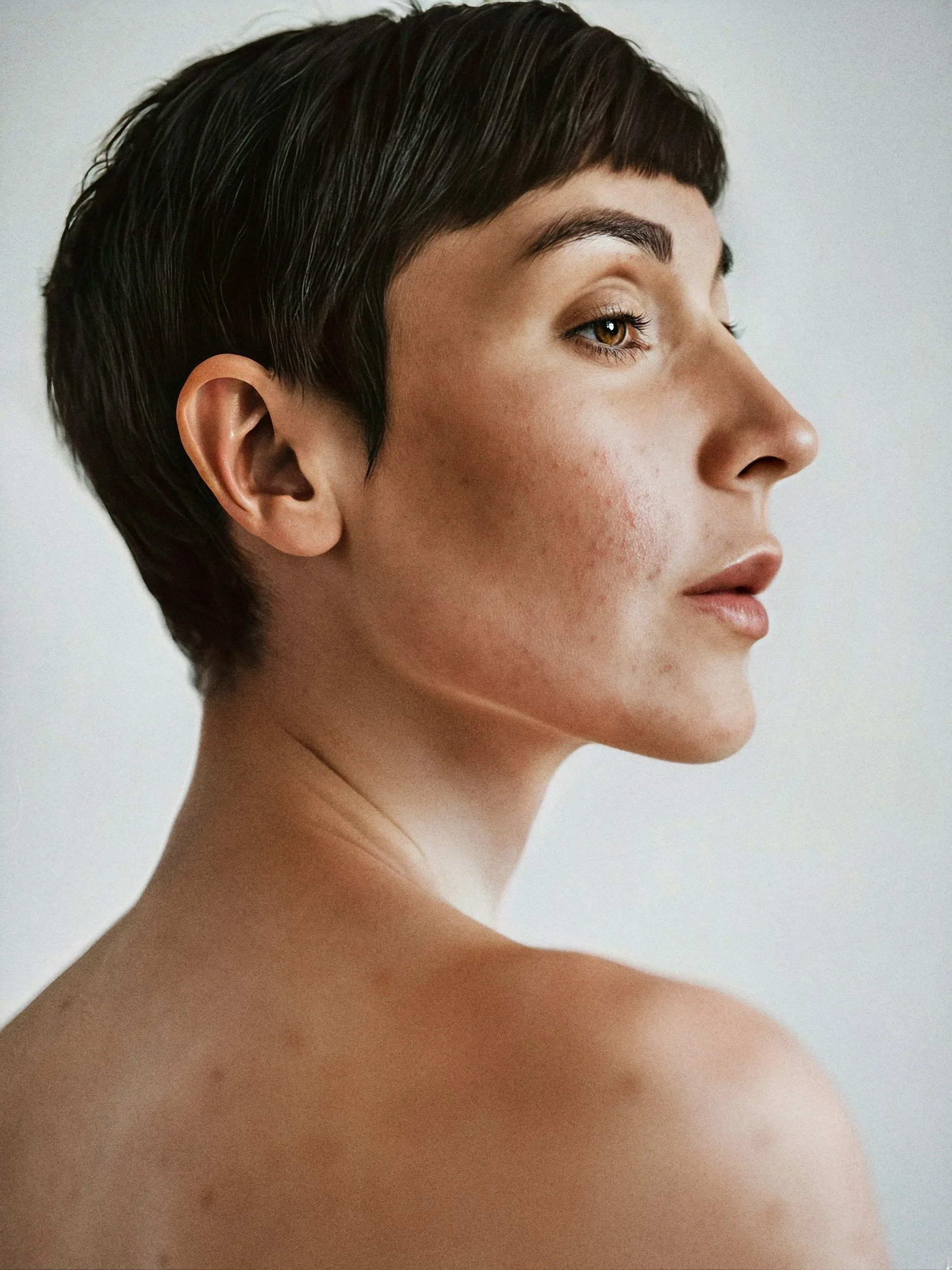 woman's profile with acne on skin