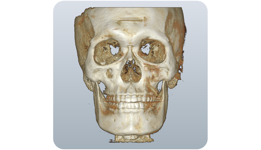 3D rendering of a human skull based on medical scan, front view