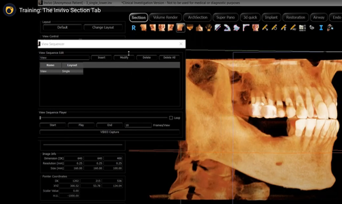 Dental 3D imaging software interface with a scan of a human jaw and teeth.