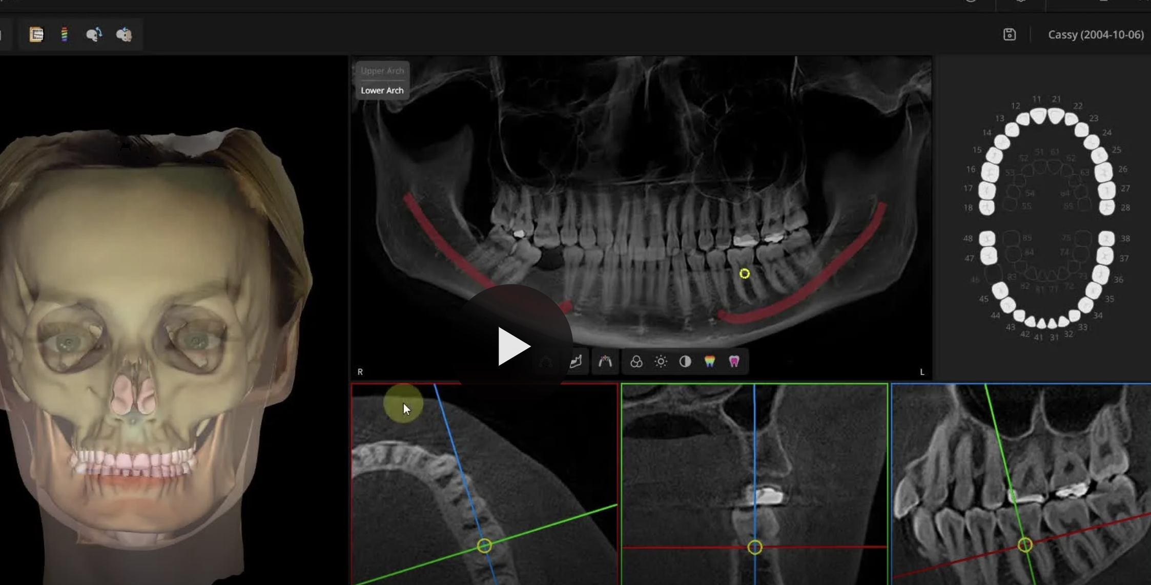 Screenshot of a medical imaging software showing 3D and X-ray images of a human skull and teeth, with various color-coded lines and annotations for dental analysis.