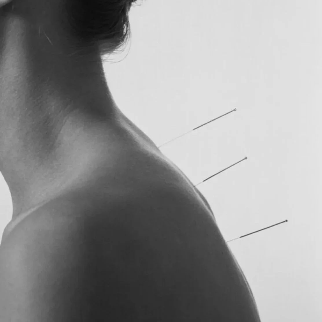 Acupuncture - Discover balance and healing through the ancient art of acupuncture. Our acupuncture services offer a comprehensive approach to wellness, and it helps identify and stimulate key points in your body to promote overall well-being.
