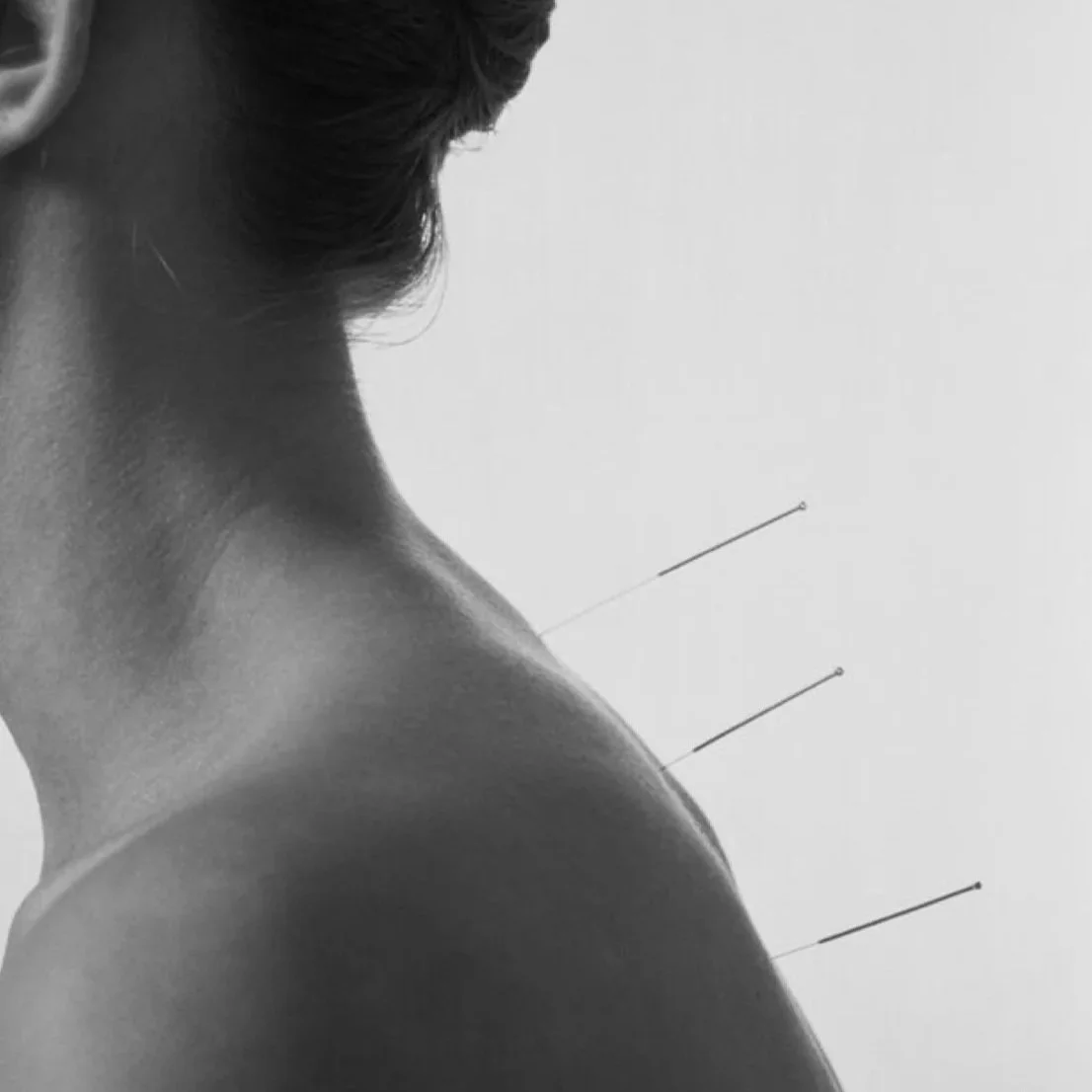 Acupuncture