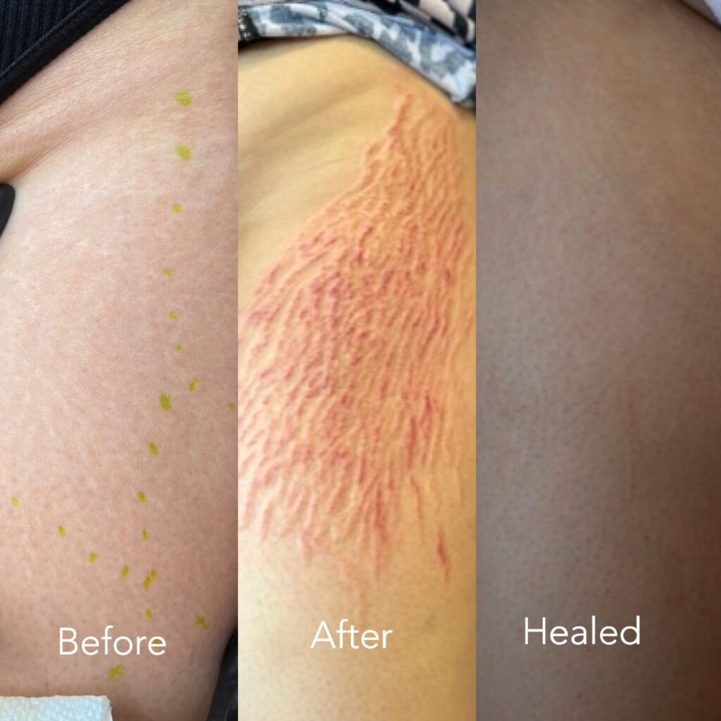 Before after healed.jpg