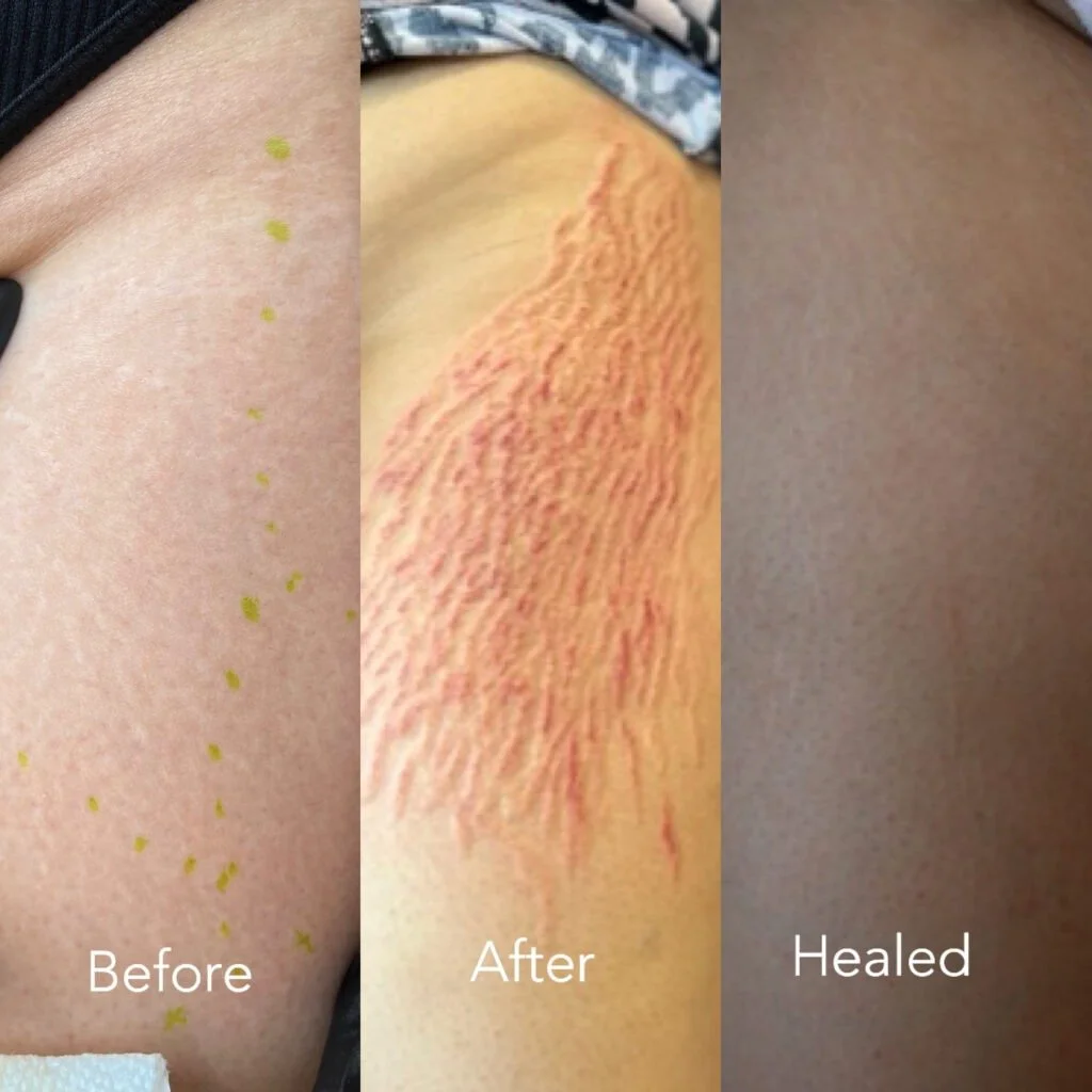 Before after healed.jpg