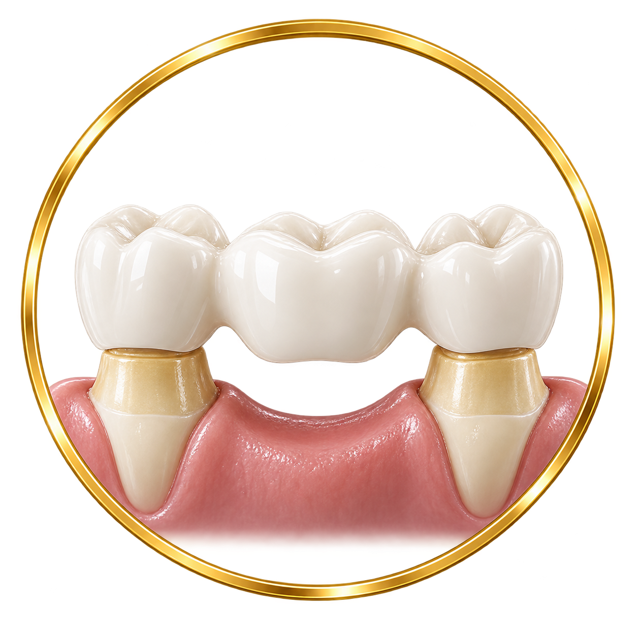 A dental model illustrating a dental bridge with artificial teeth supported by natural teeth.
