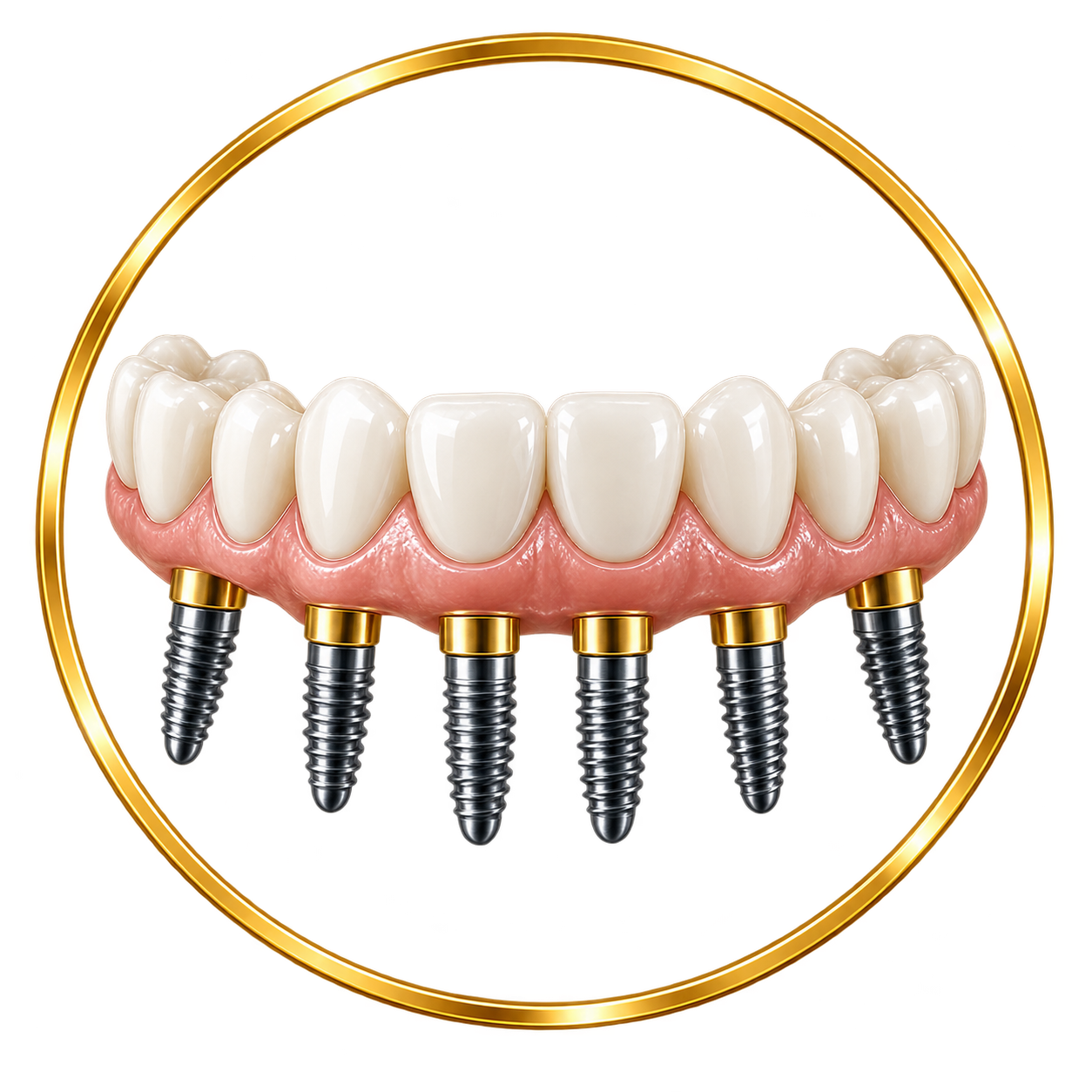 A dental implant depicting a full set of teeth attached to multiple titanium screws embedded in the gums, with a circular metallic border in the background.