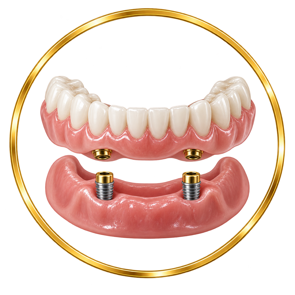 Dental implant model with artificial teeth attached to a metal framework, showing upper and lower jaw implants and screws.