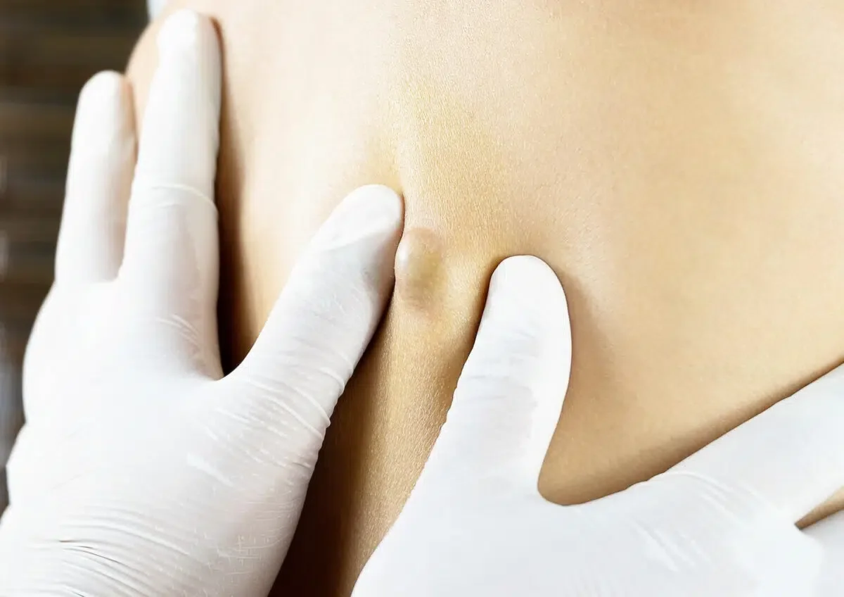 Tratamento cirúrgico da hidradenite supurativa: quando a cirurgia pode ser indicada