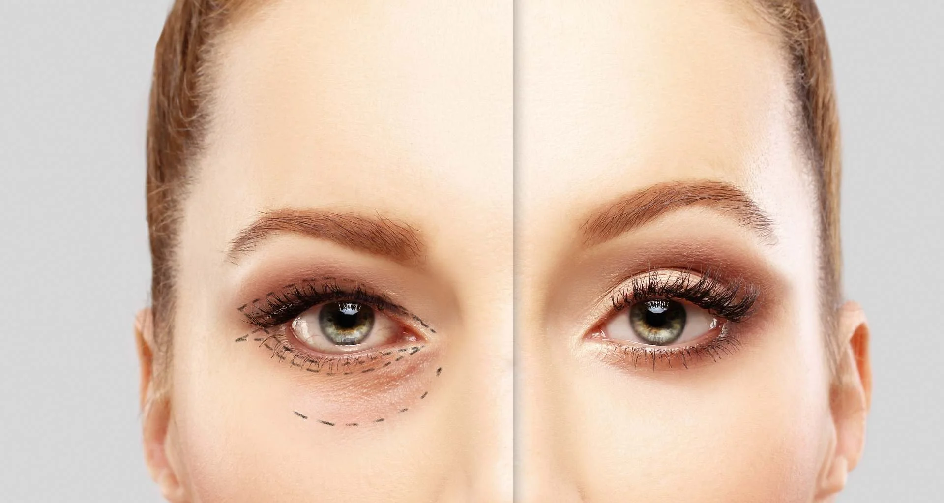 Imagem de um rosto feminino, com uma metade mostrando sinais de cirurgia estética de olhos e a outra metade após o procedimento, evidenciando a diferença na aparência das pálpebras.