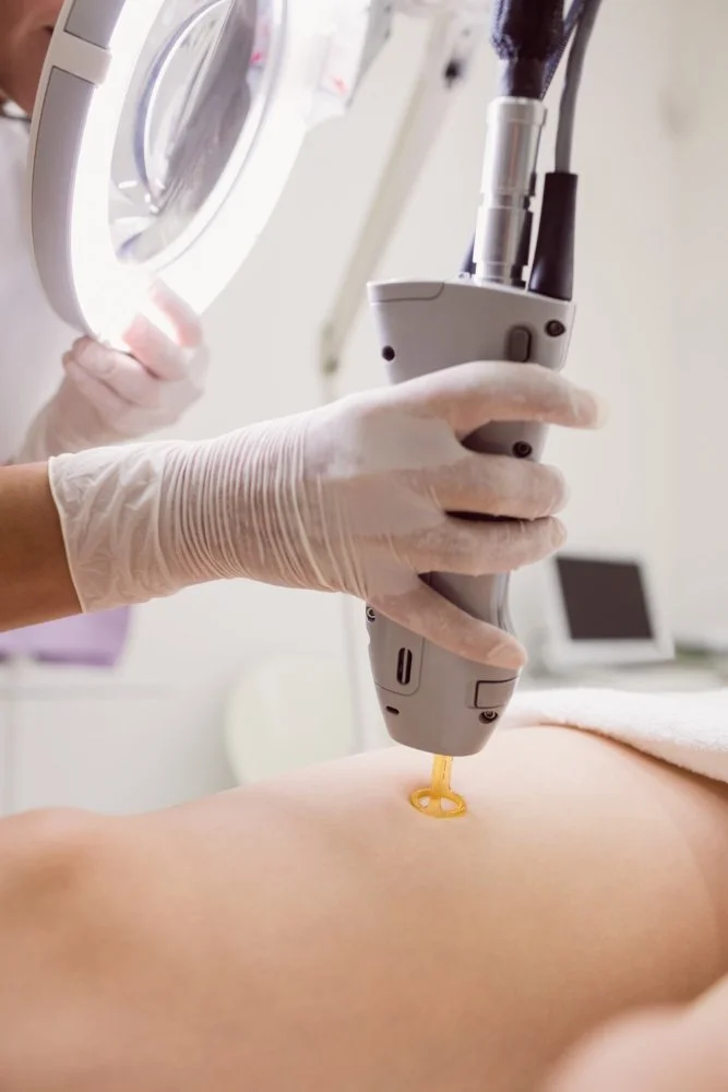 Procedimento de dermatologia com laser em uma clínica, profissional usando luvas segurando equipamento de laser sobre a pele de um paciente.