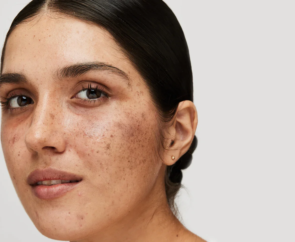 Close-up de uma mulher com pele com muitas sardas e manchas, cabelo escuro e preso na nuca, usando brincos pequenos, com expressão neutra, fundo branco.