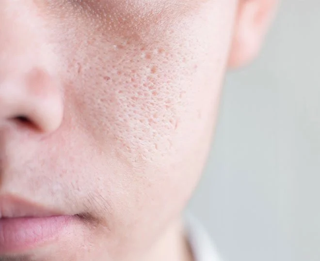 Close-up de uma pessoa com pele avermelhada e poros dilatados, indicando pele oleosa ou com acne.