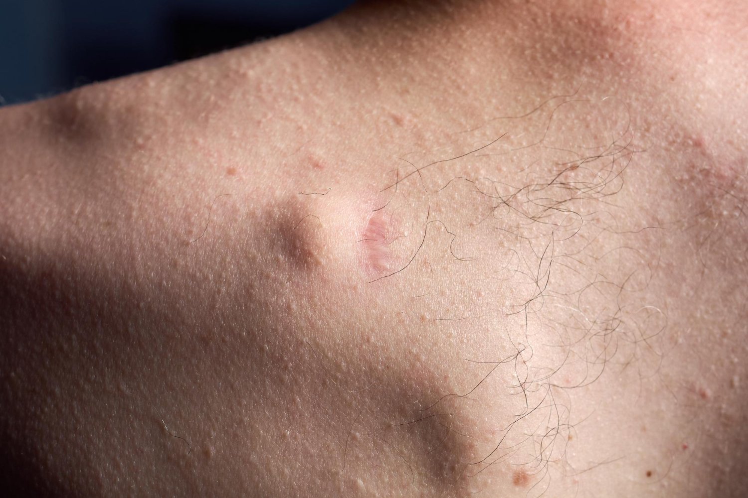 Pele humana com poros dilatados, alguns acne e pelos finos.